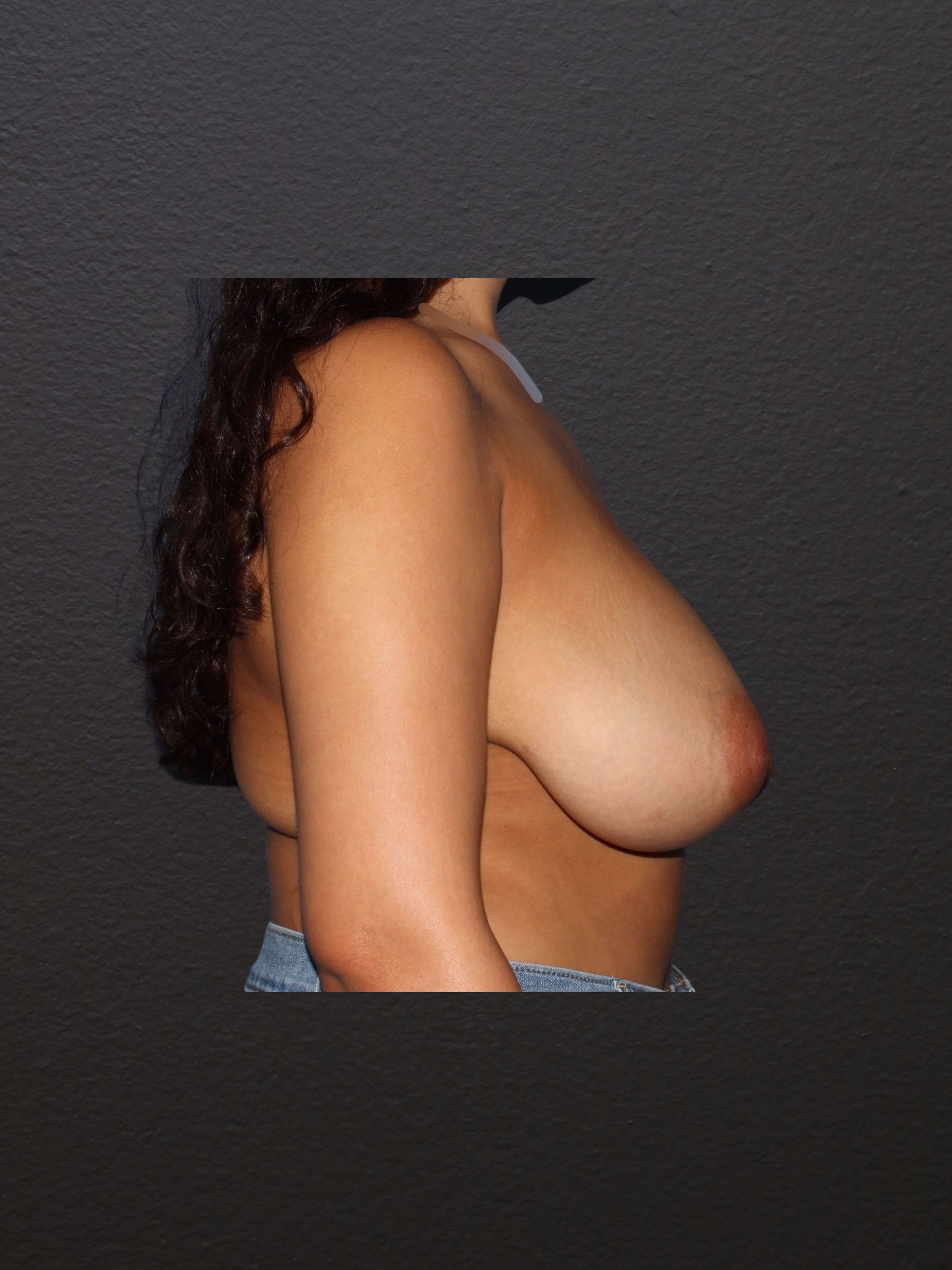 RIGHT LATERAL Before