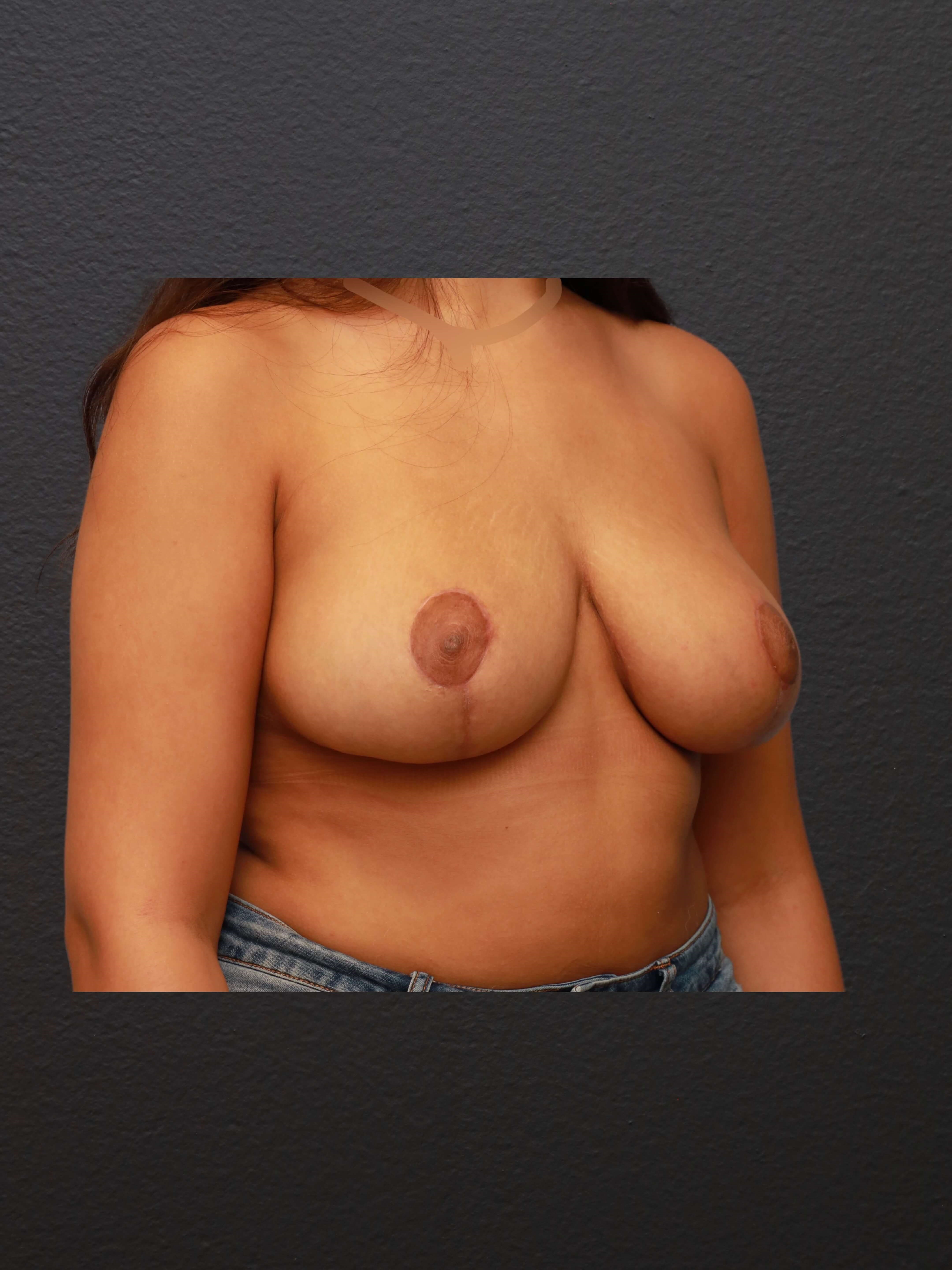 RIGHT OBLIQUE After