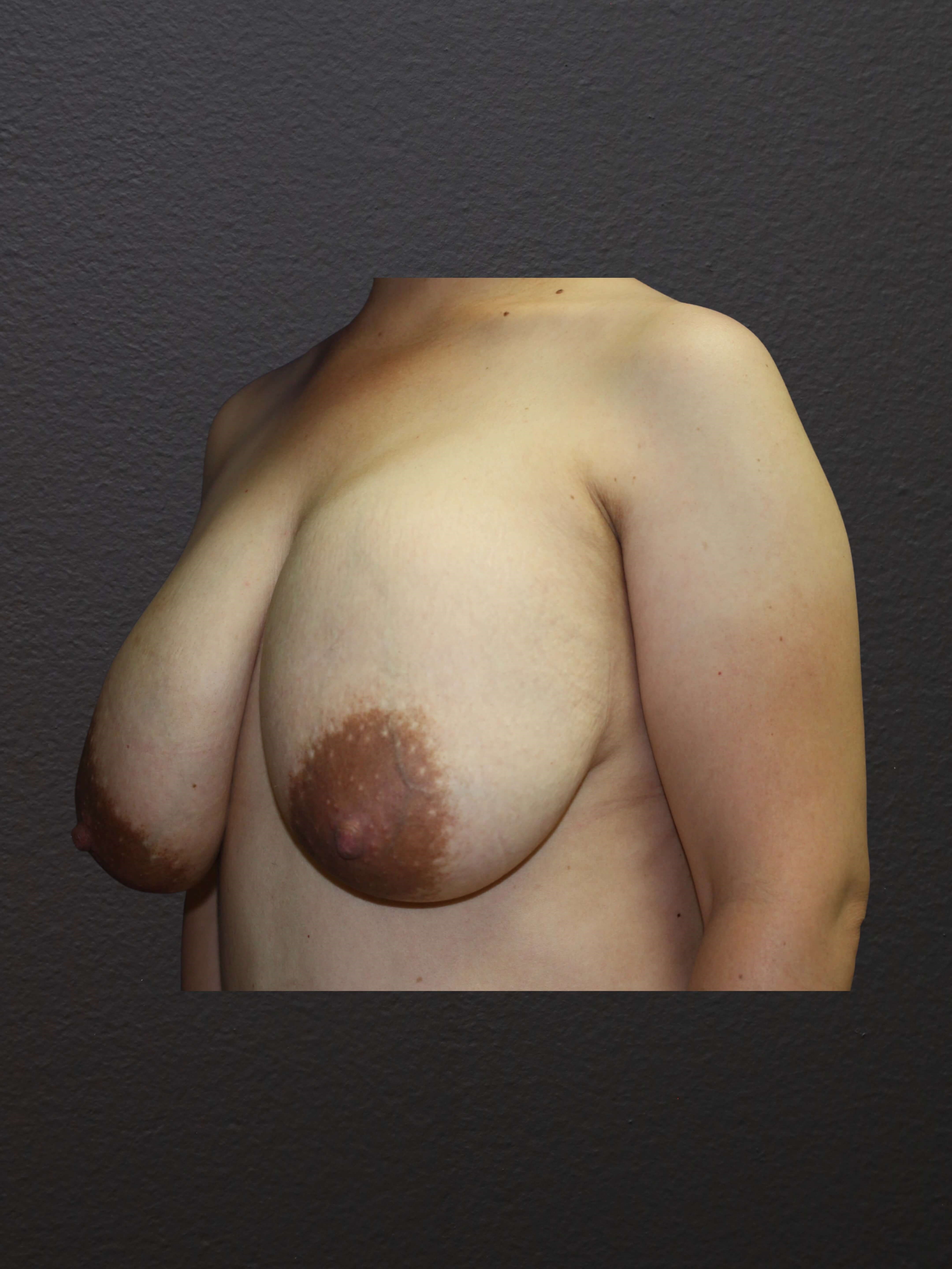 LEFT OBLIQUE Before