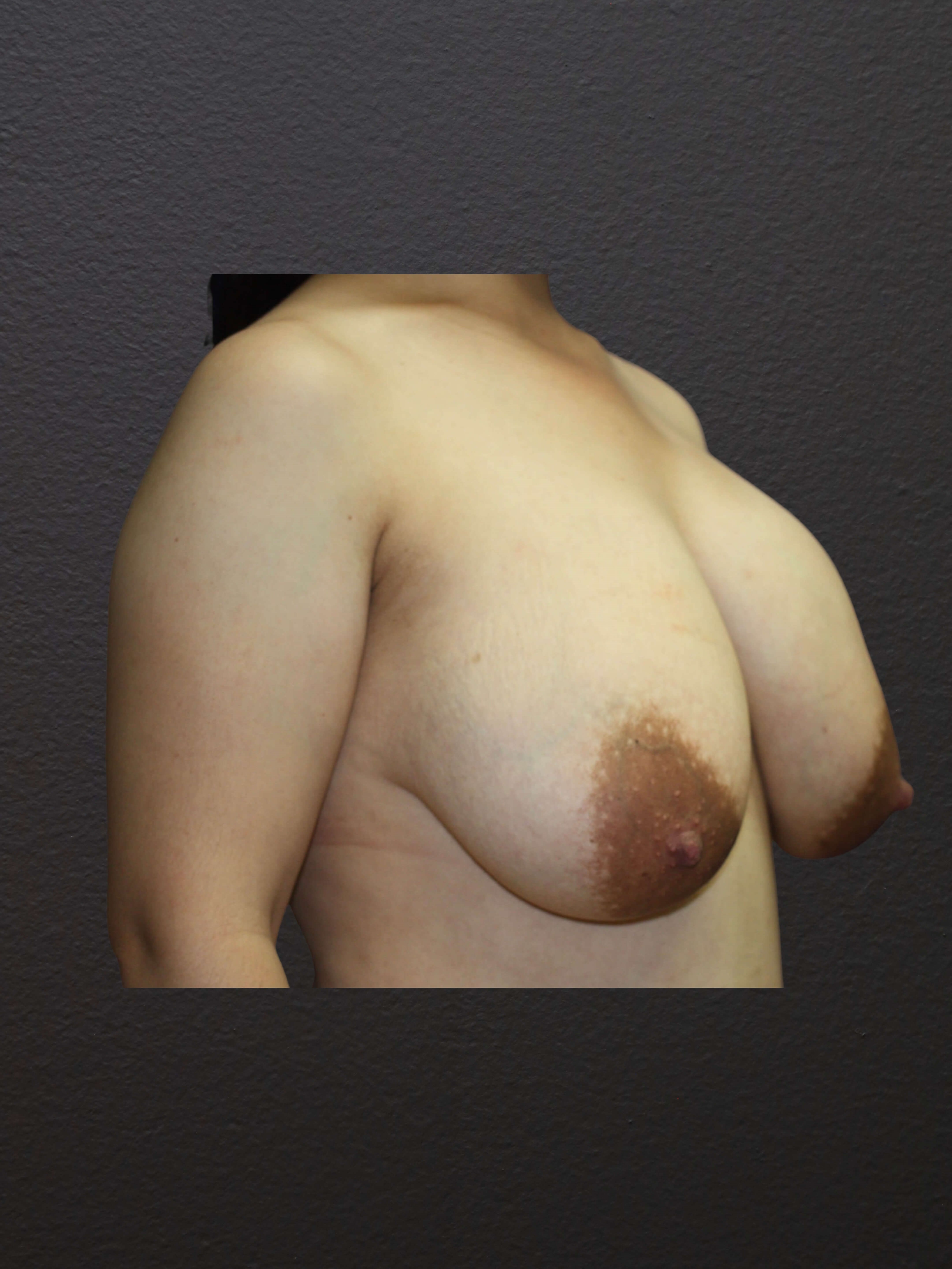 RIGHT OBLIQUE Before