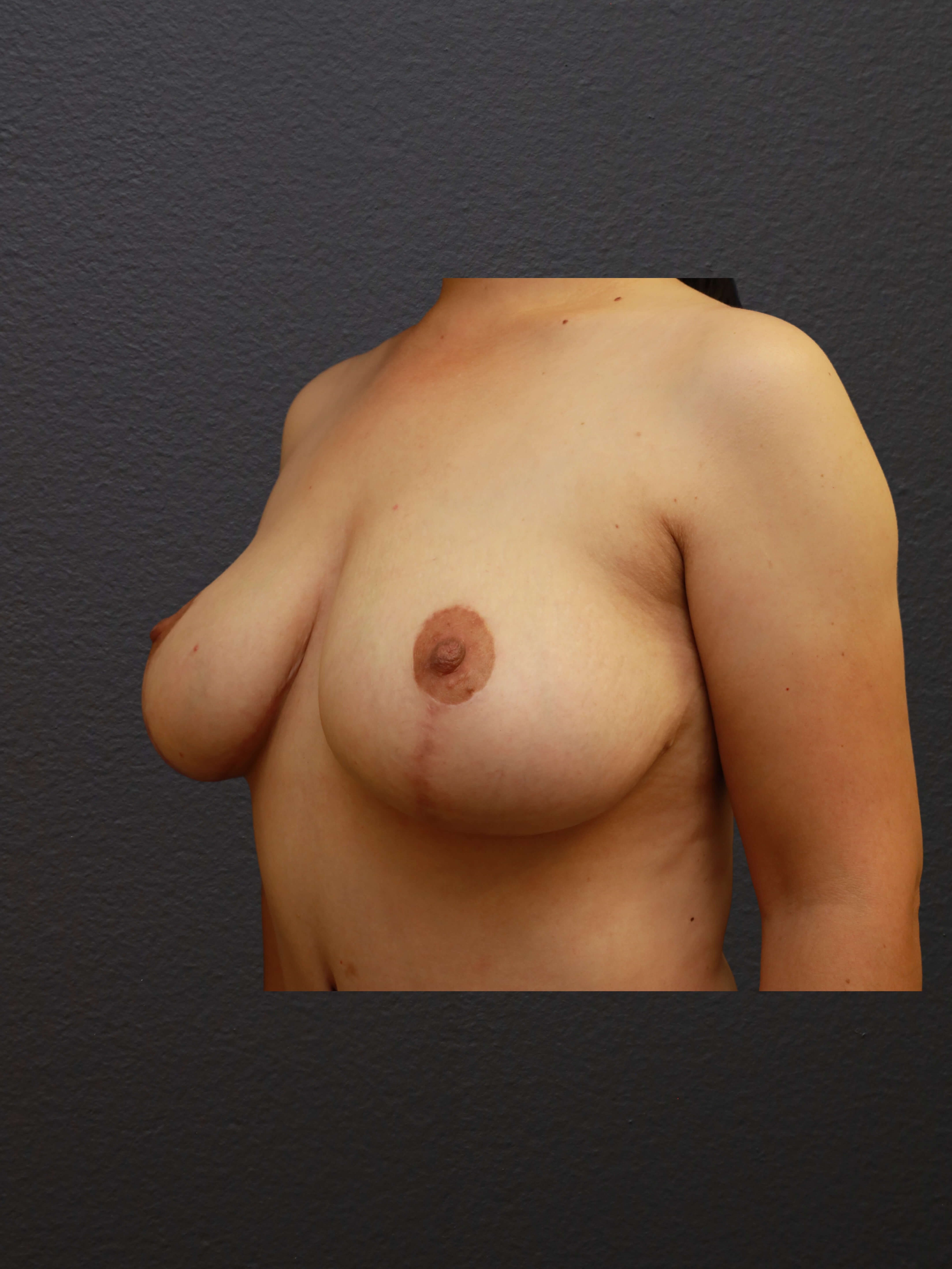 LEFT OBLIQUE After