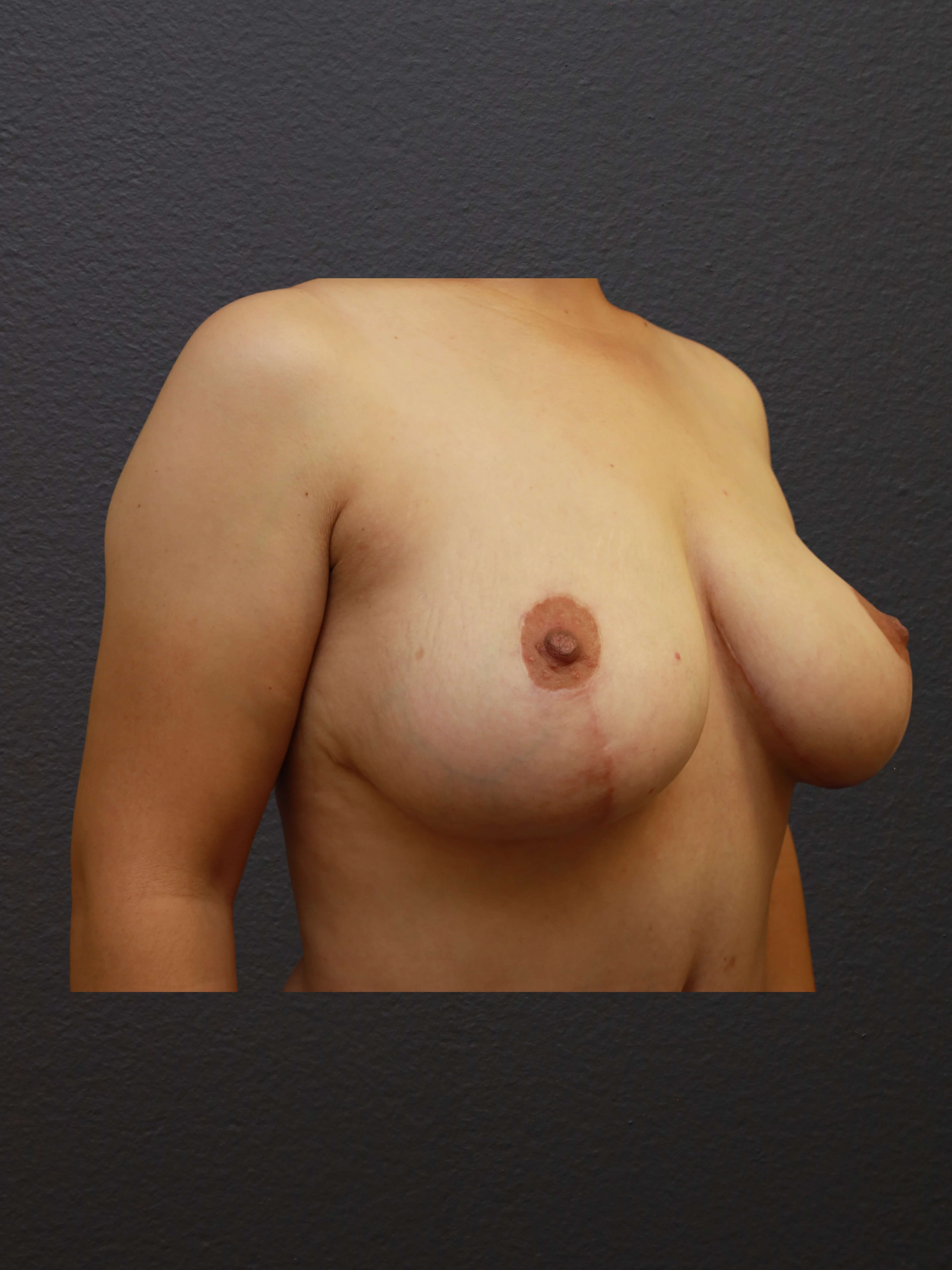 RIGHT OBLIQUE After