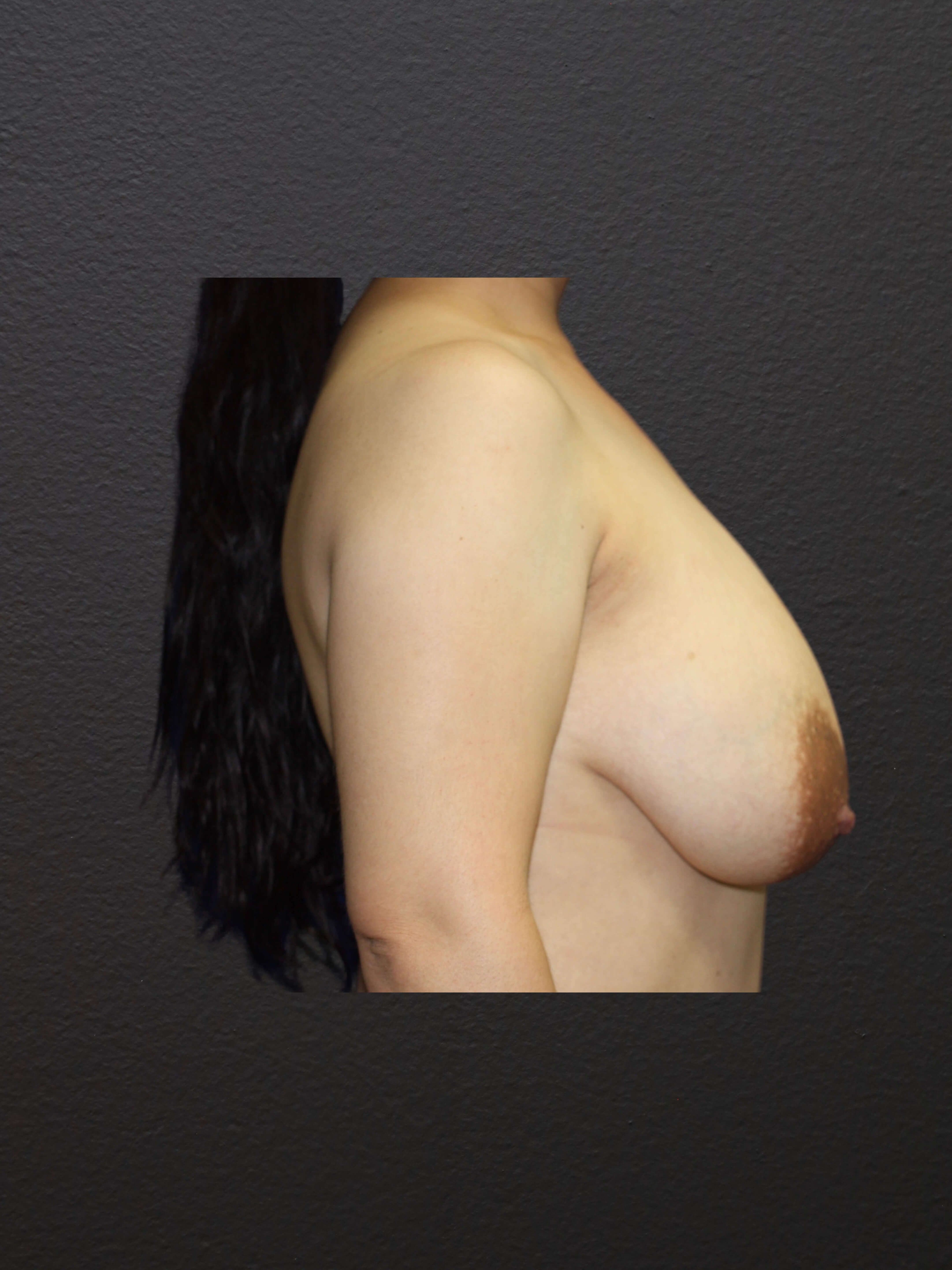 RIGHT LATERAL Before