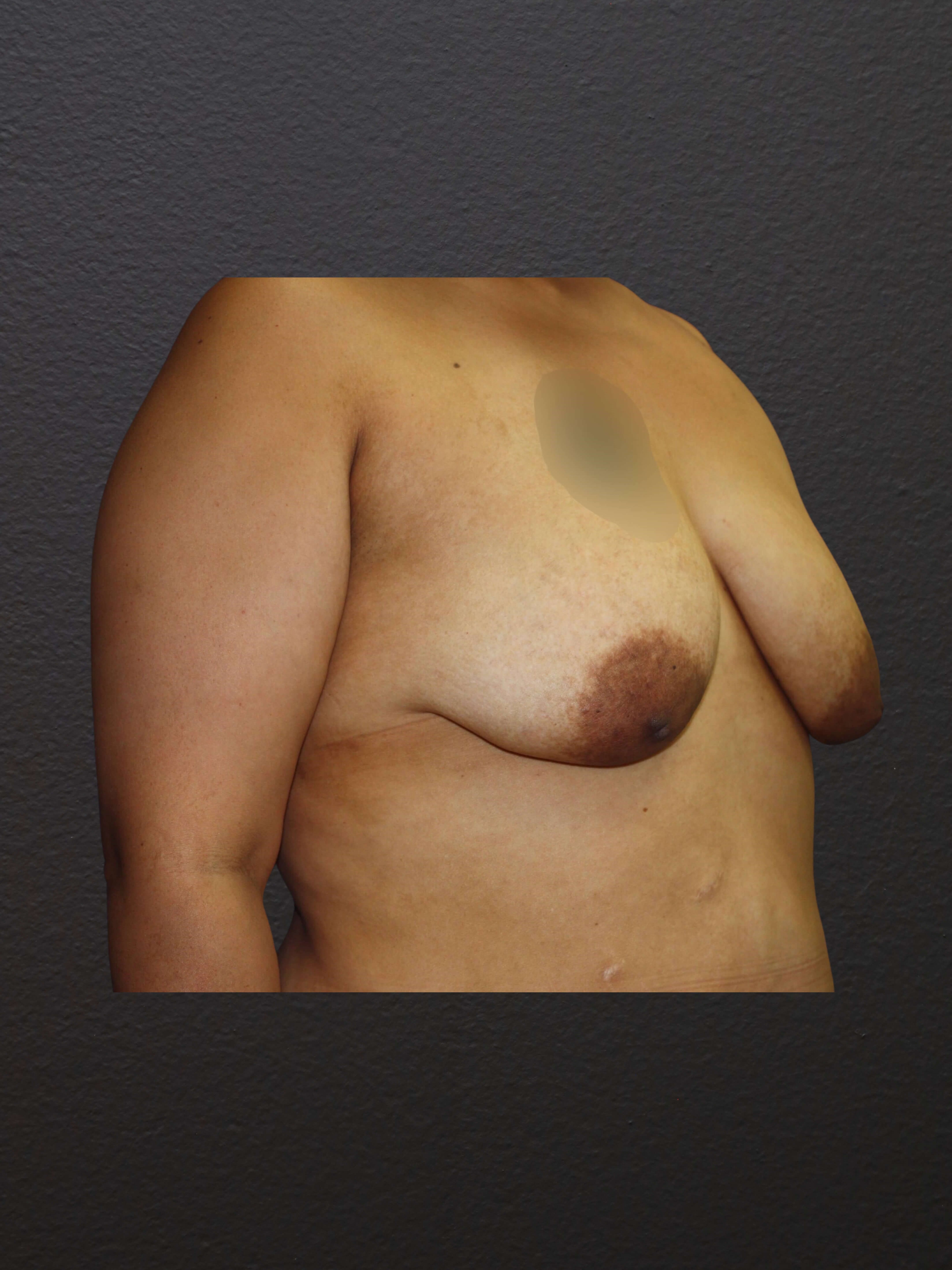 RIGHT OBLIQUE Before