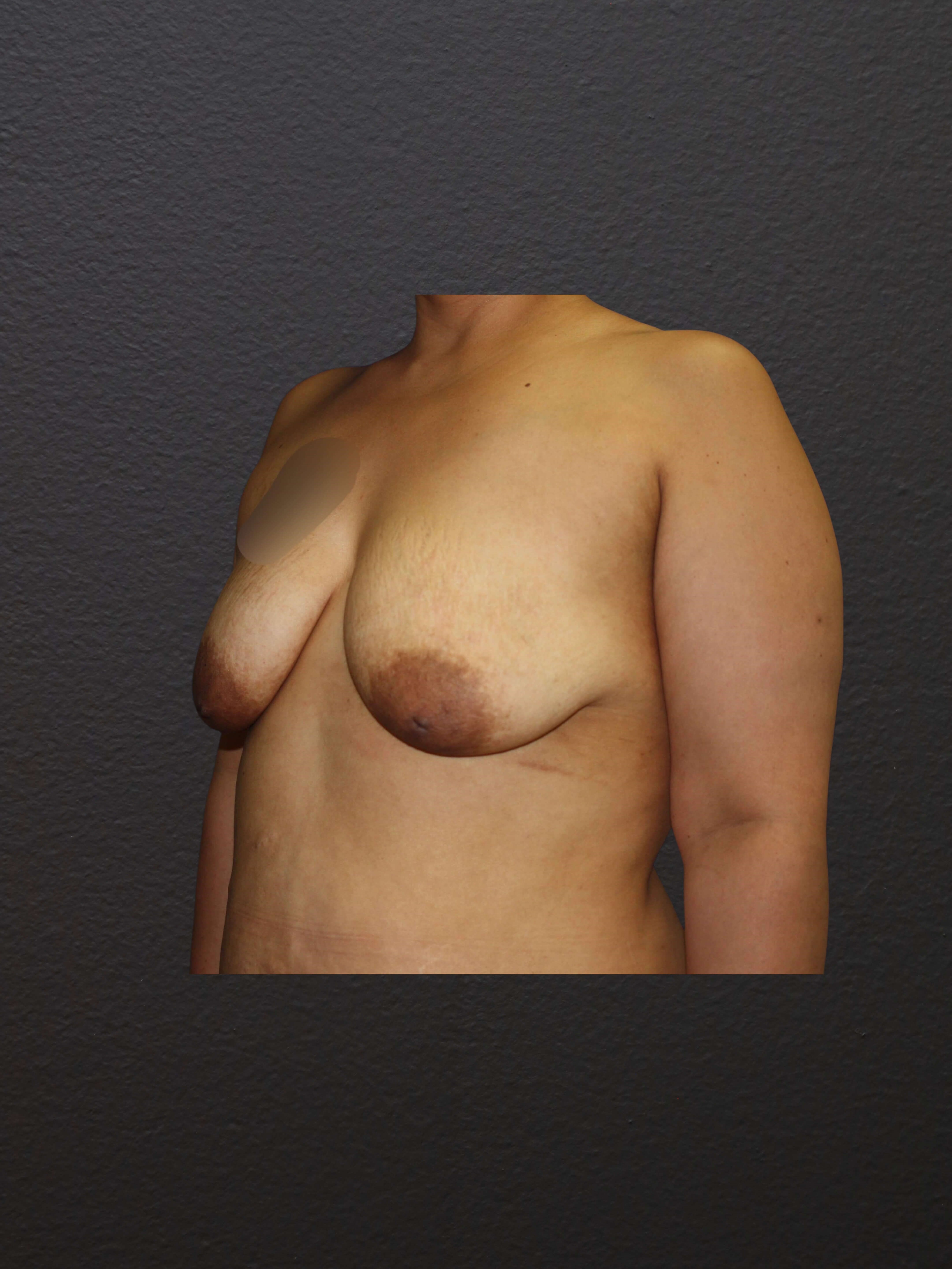LEFT OBLIQUE Before