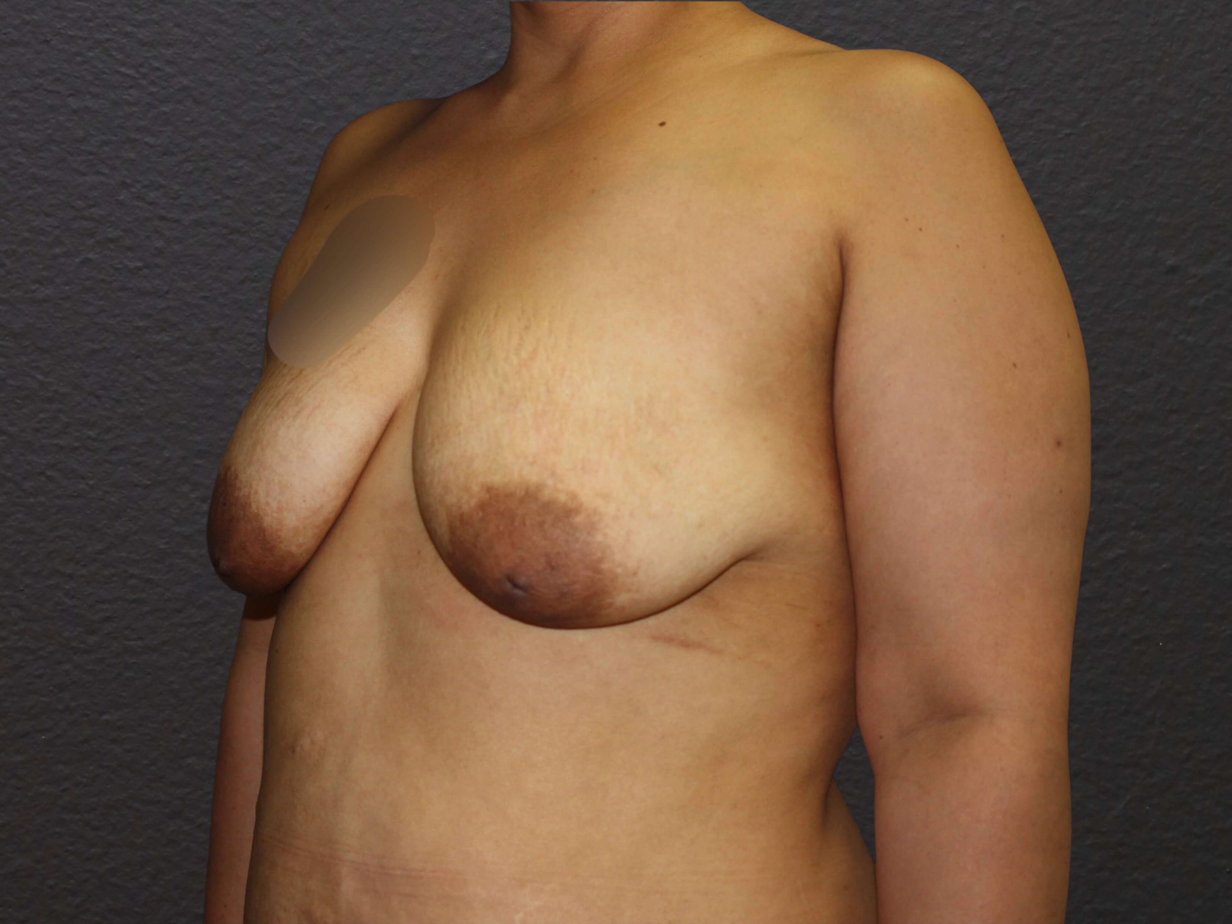 LEFT OBLIQUE Before