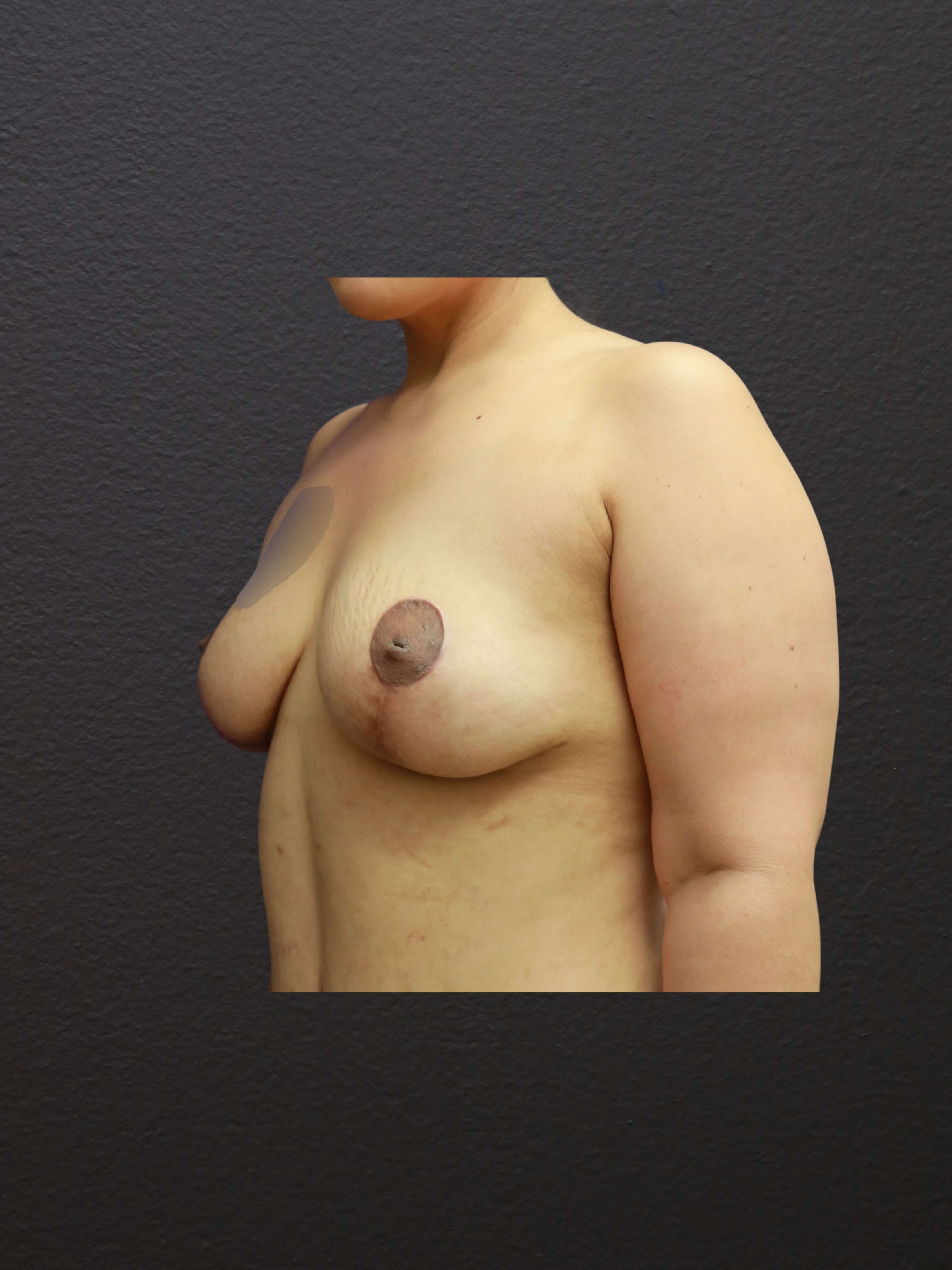 LEFT OBLIQUE After