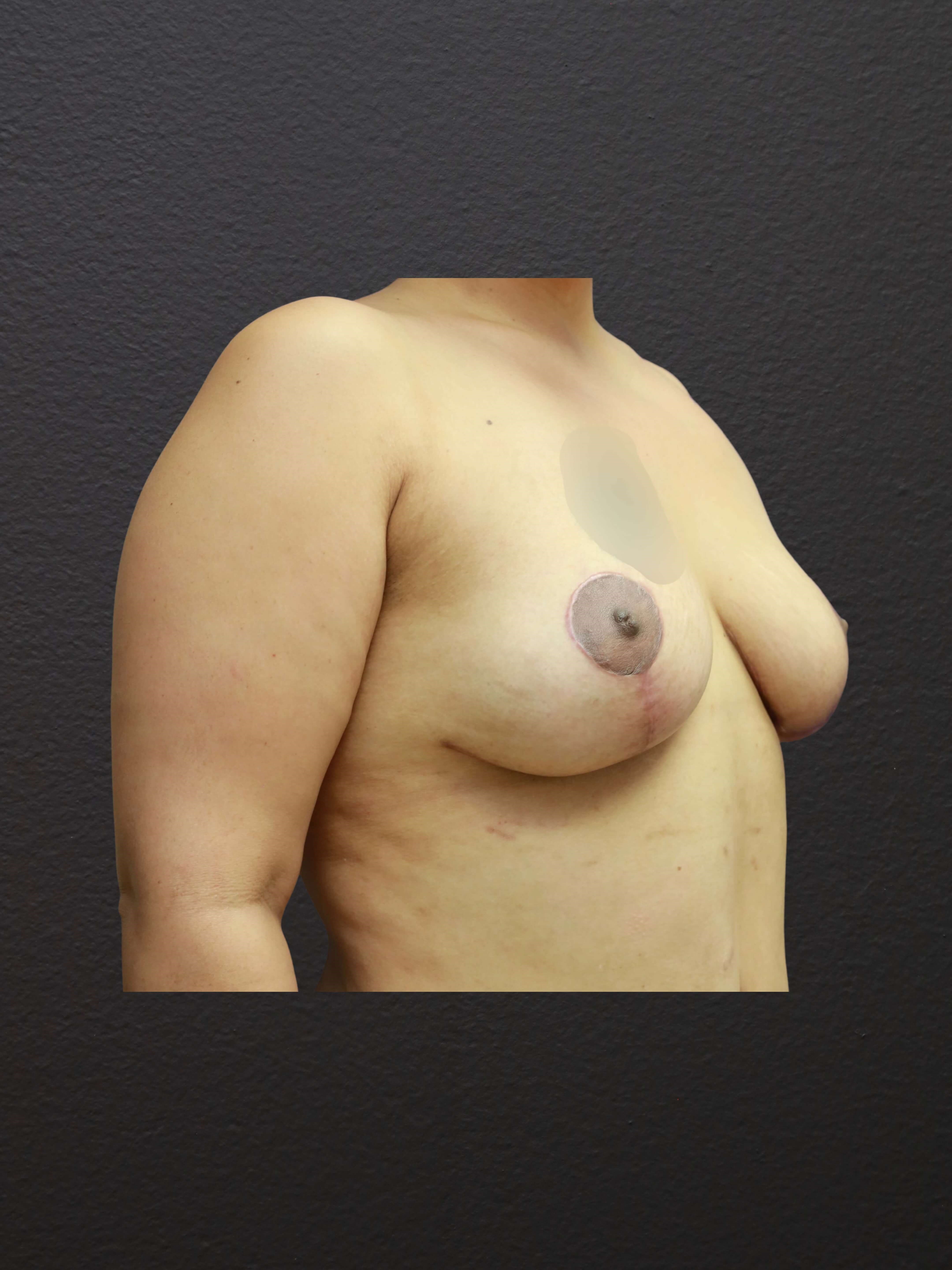 RIGHT OBLIQUE After
