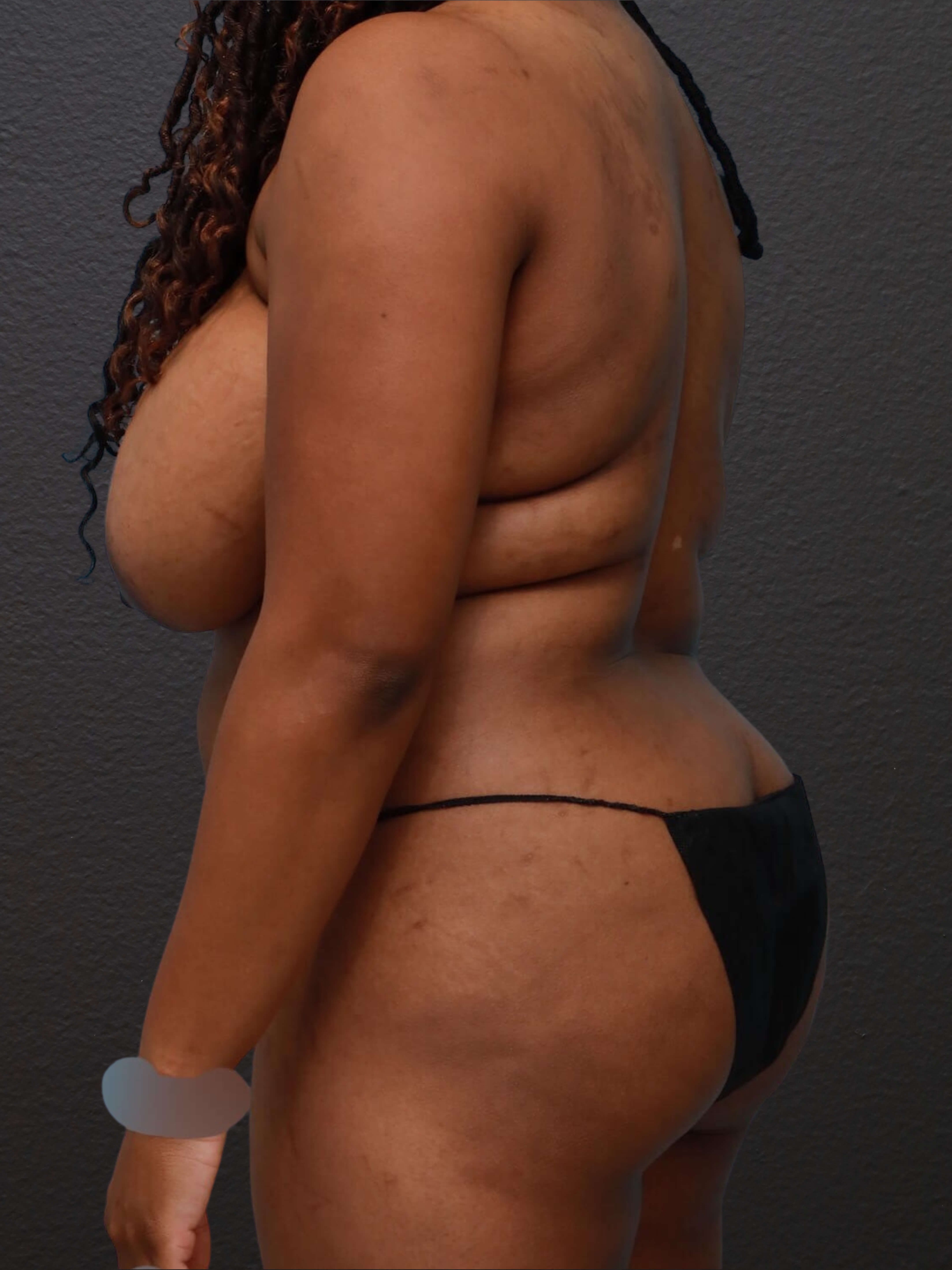 Left Back Oblique Before