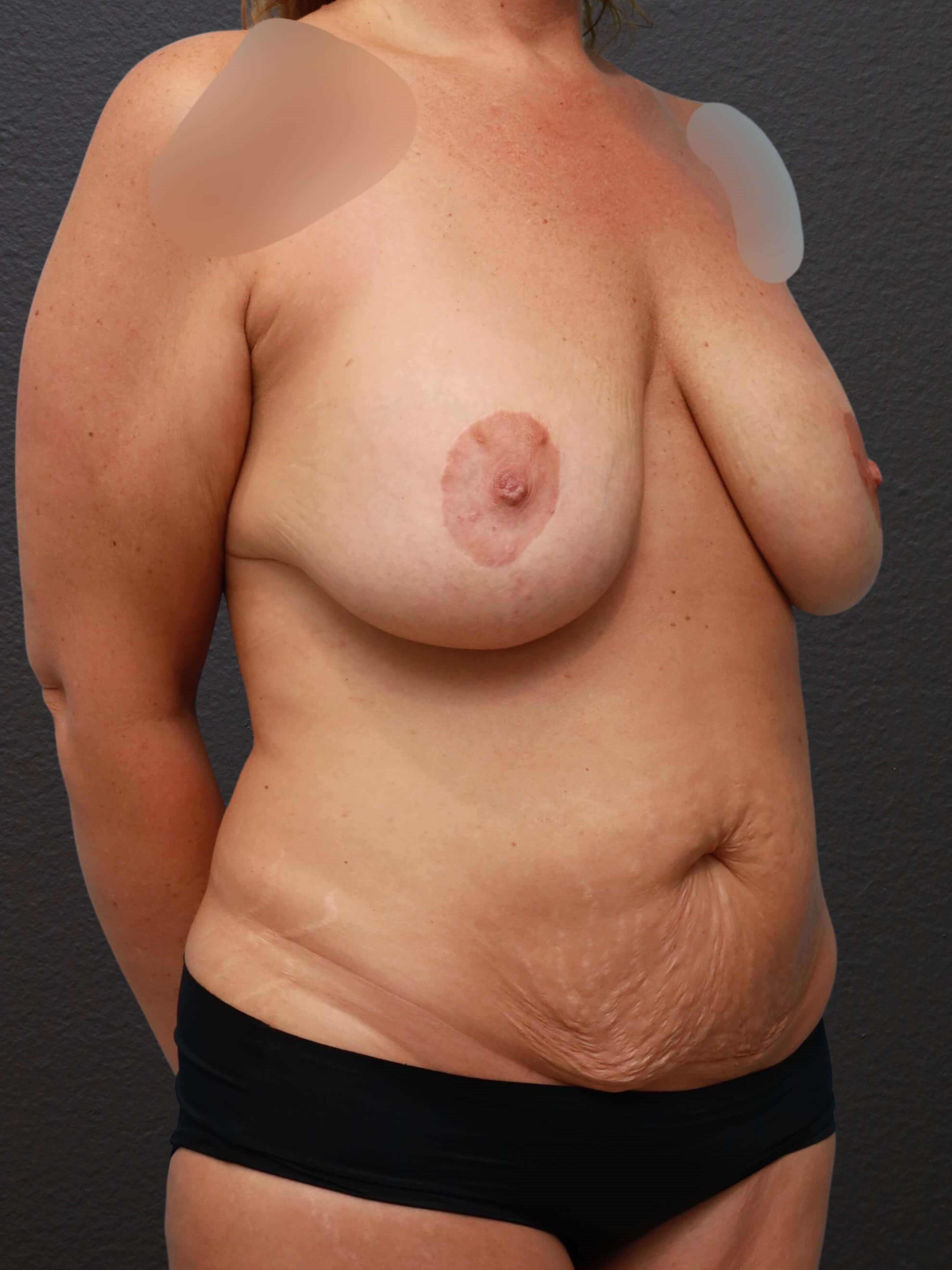 Right Oblique Before