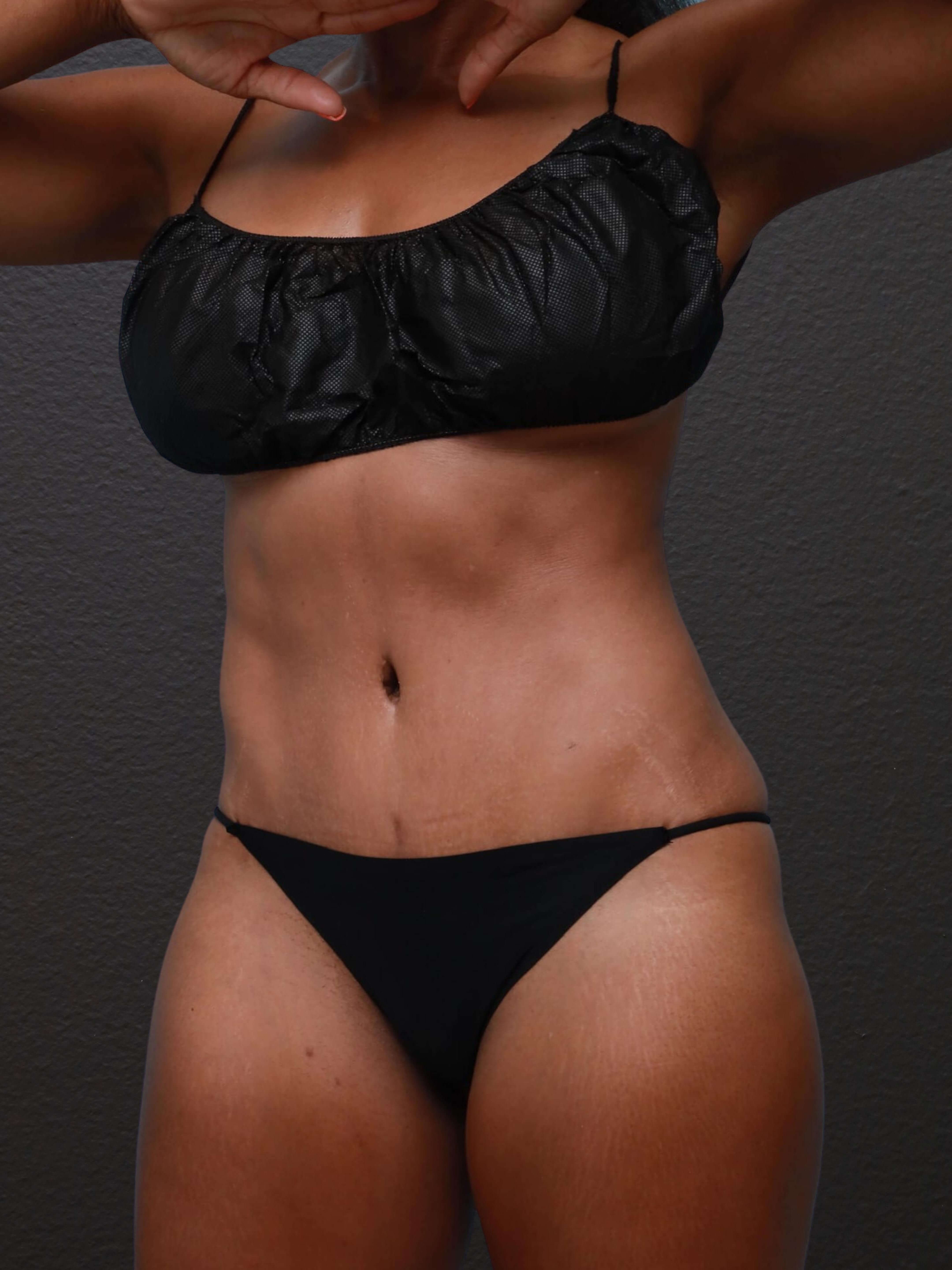 Left Oblique After