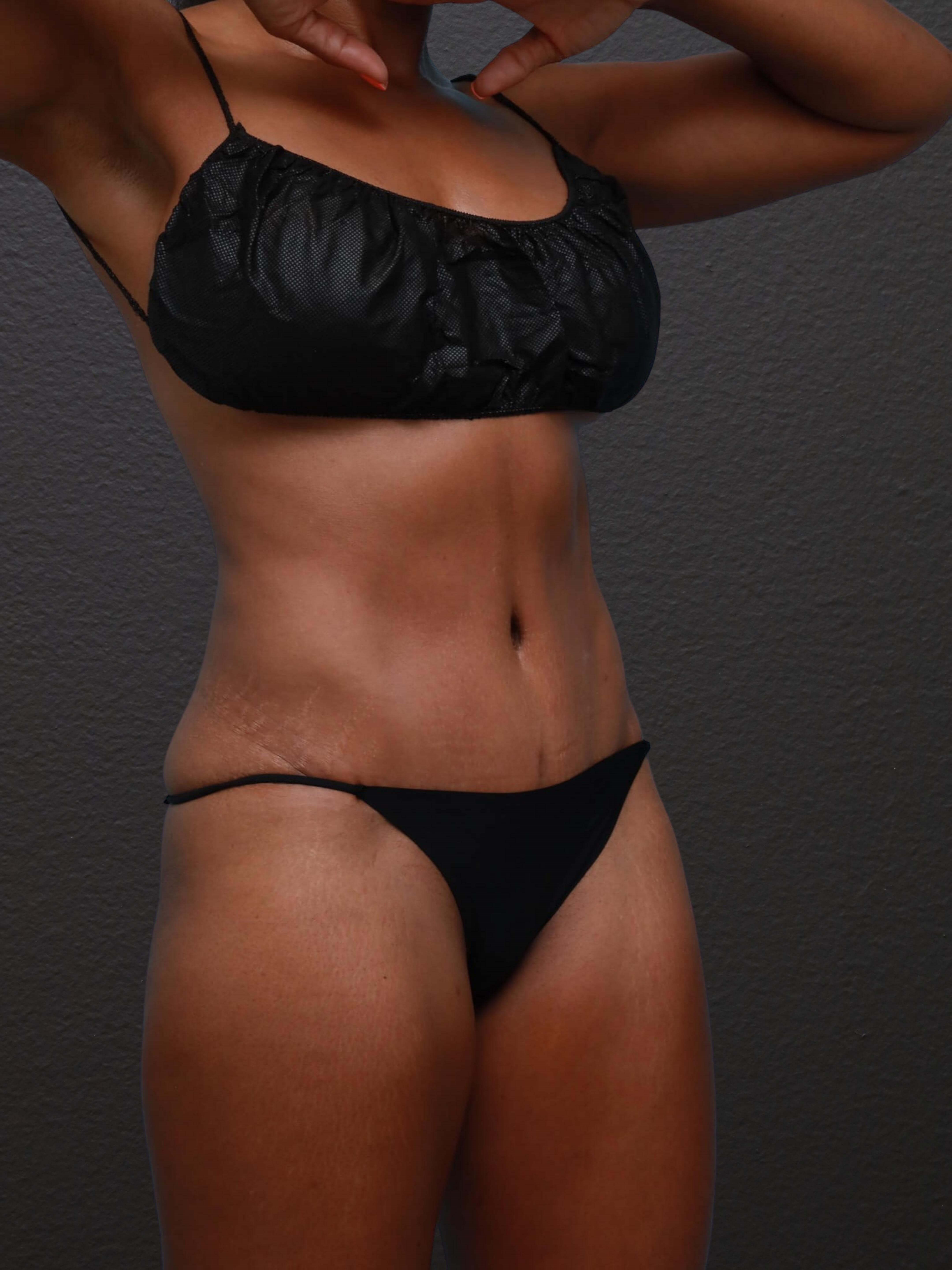 Right Oblique After