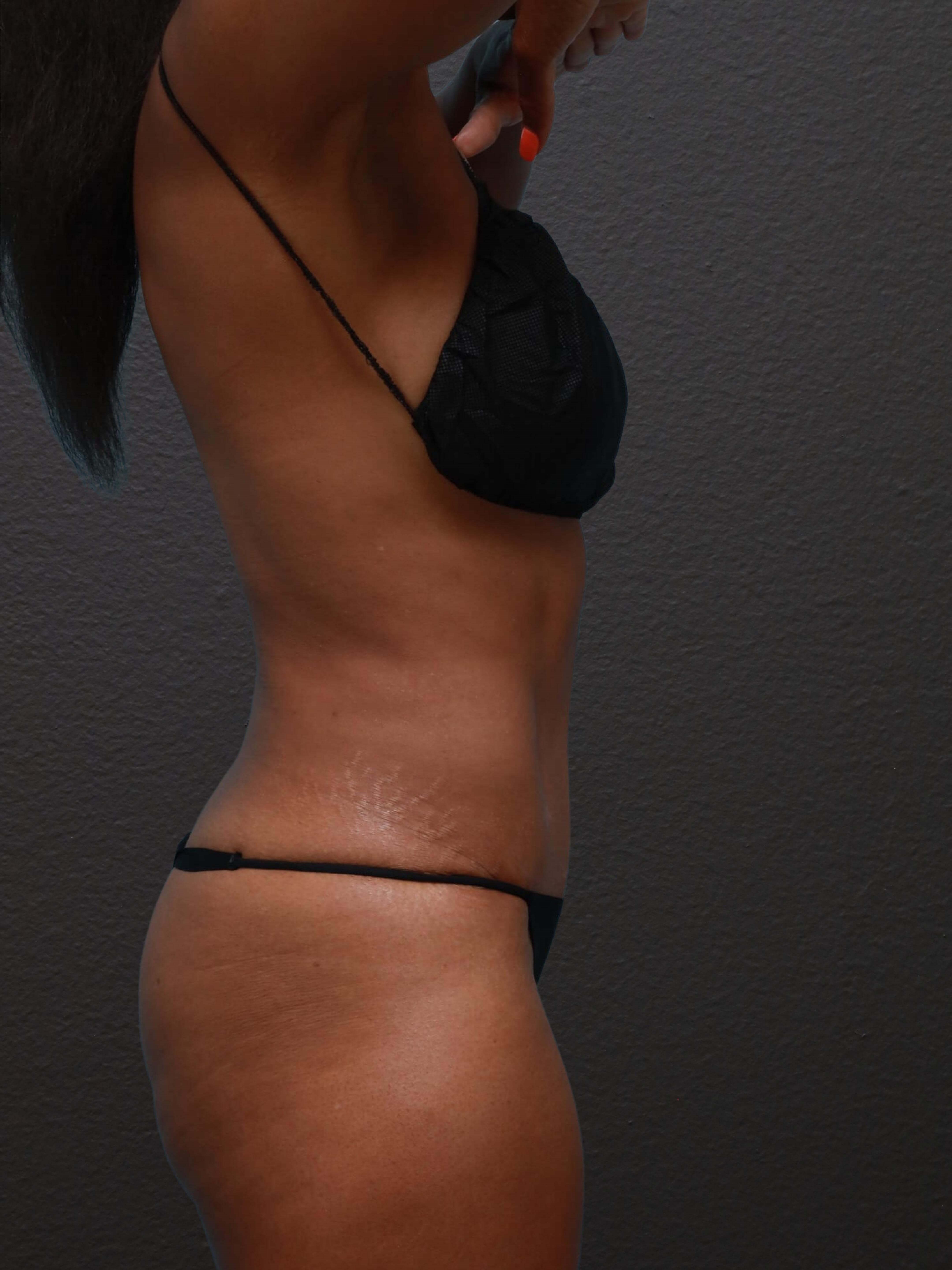 Right Lateral After