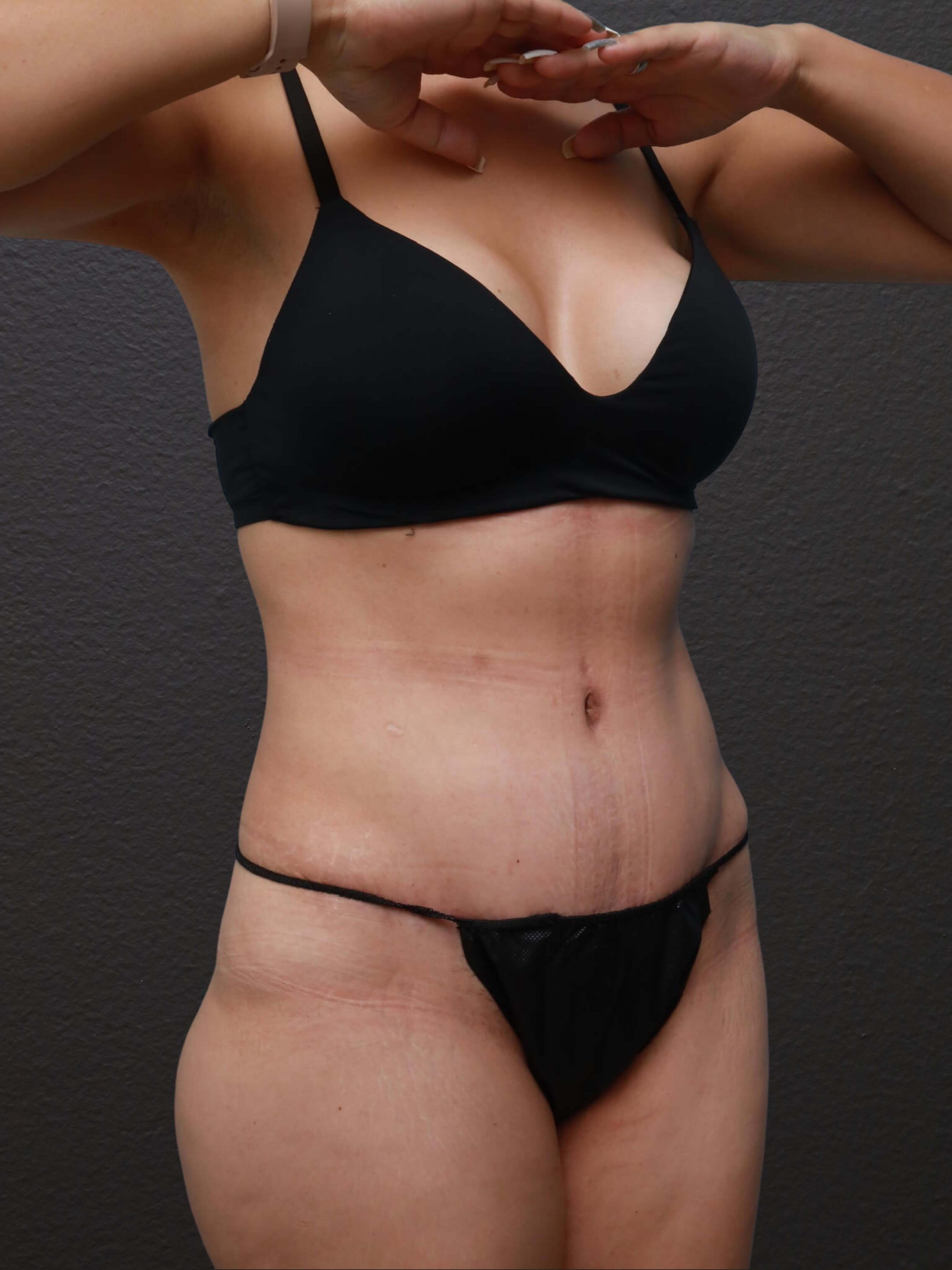 Right Oblique After