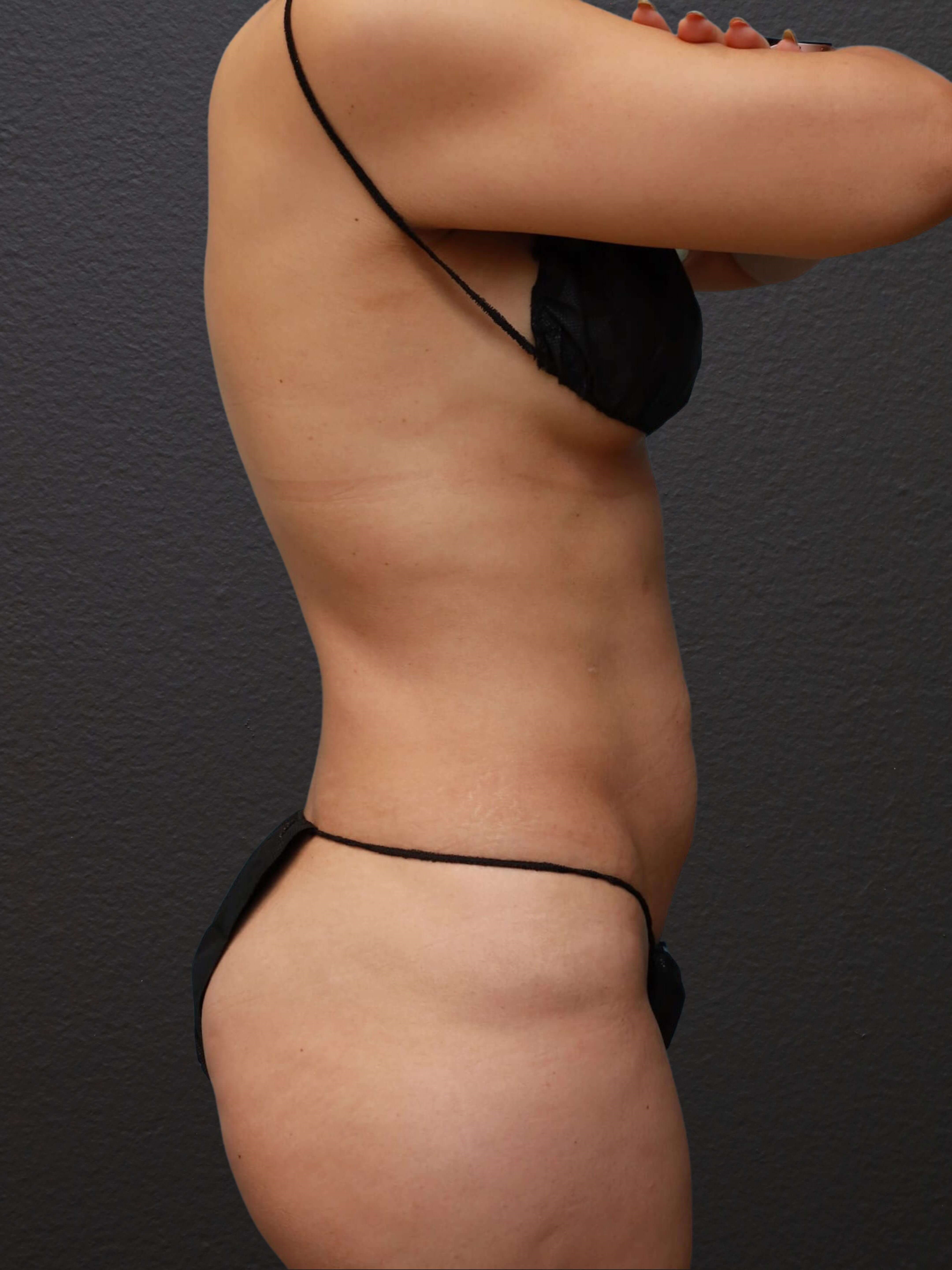 Right Lateral Before