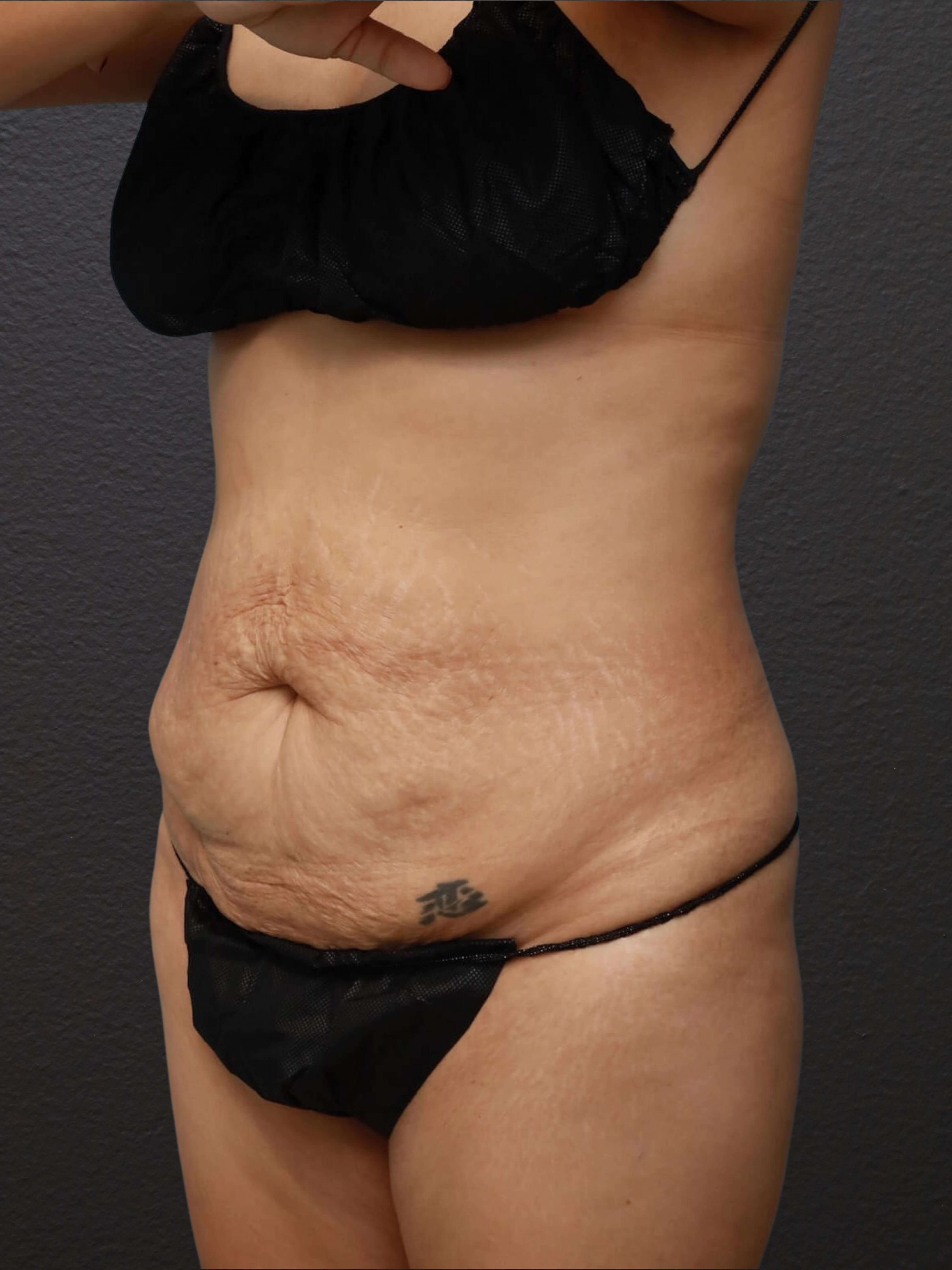 Left Oblique Before