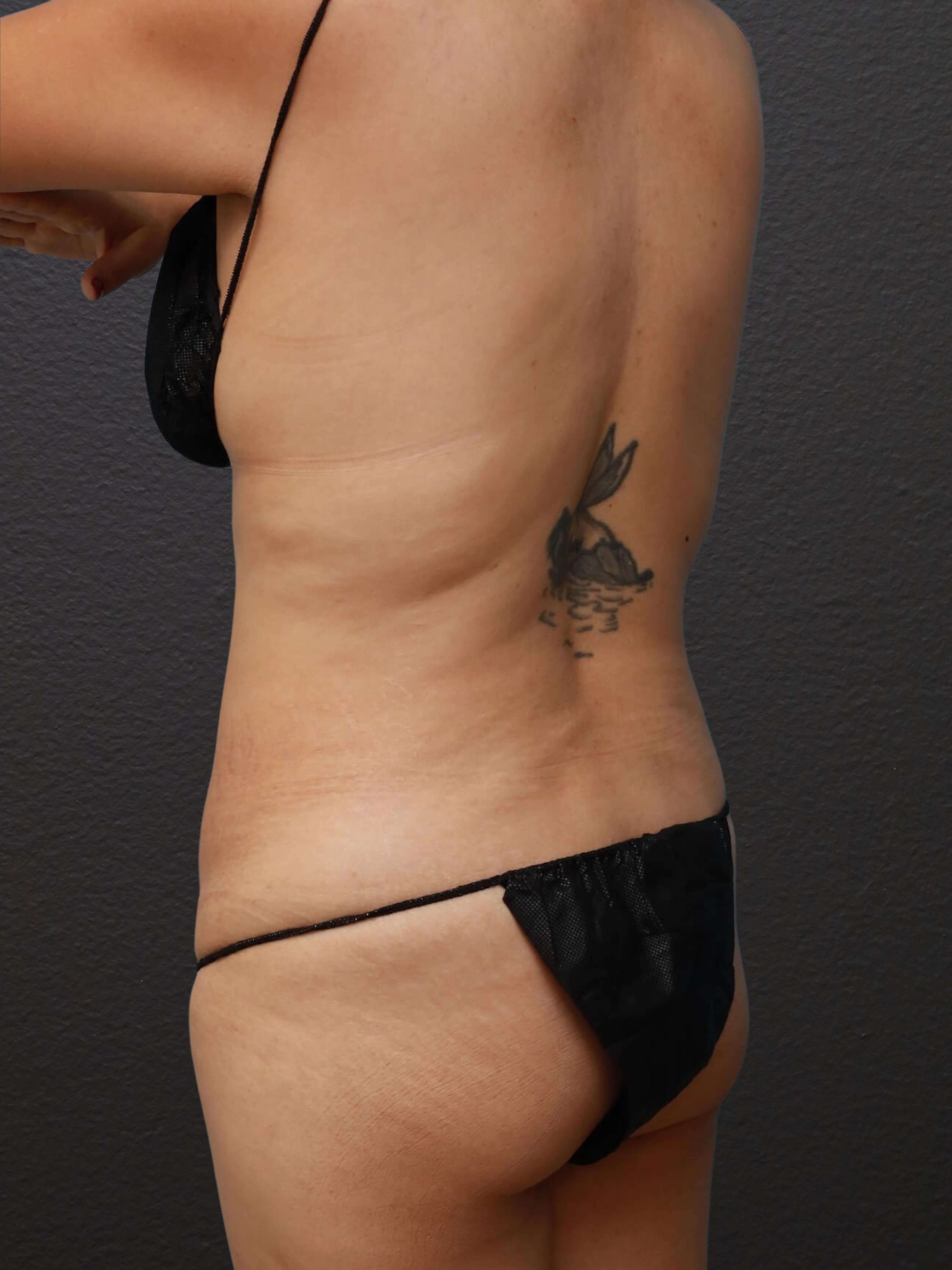 Left Back Oblique Before