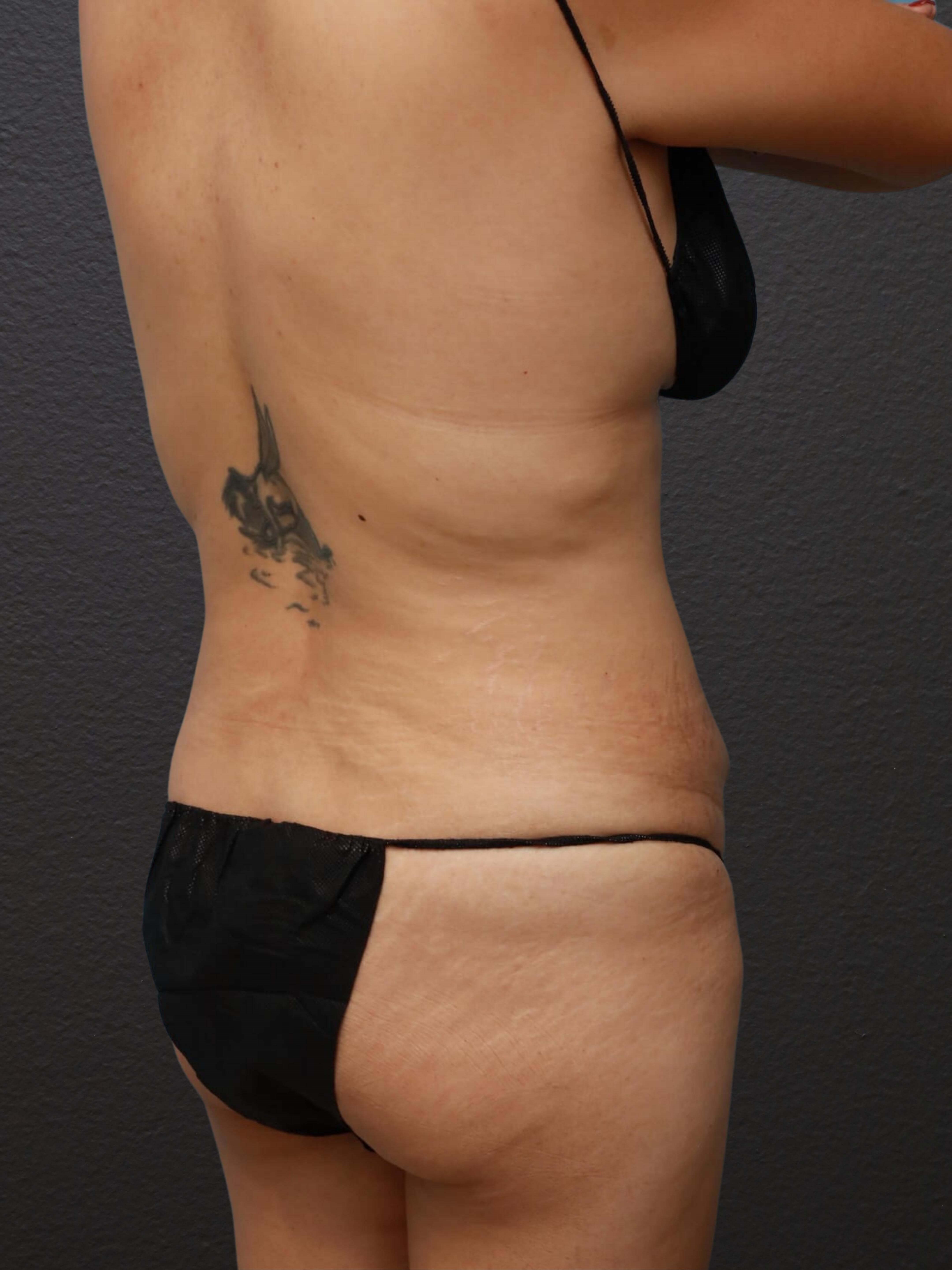 Right Back Oblique Before