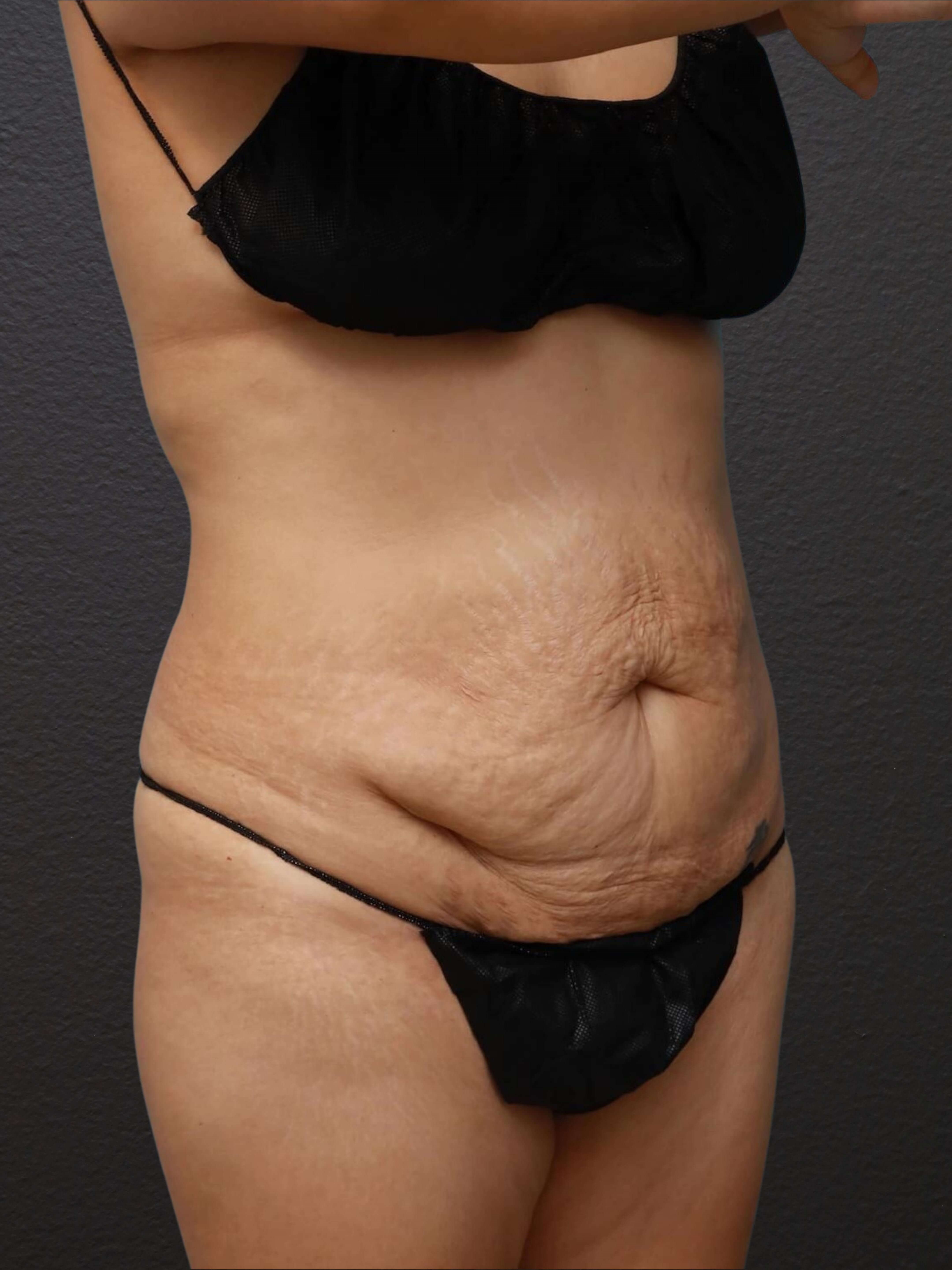 Right Oblique 