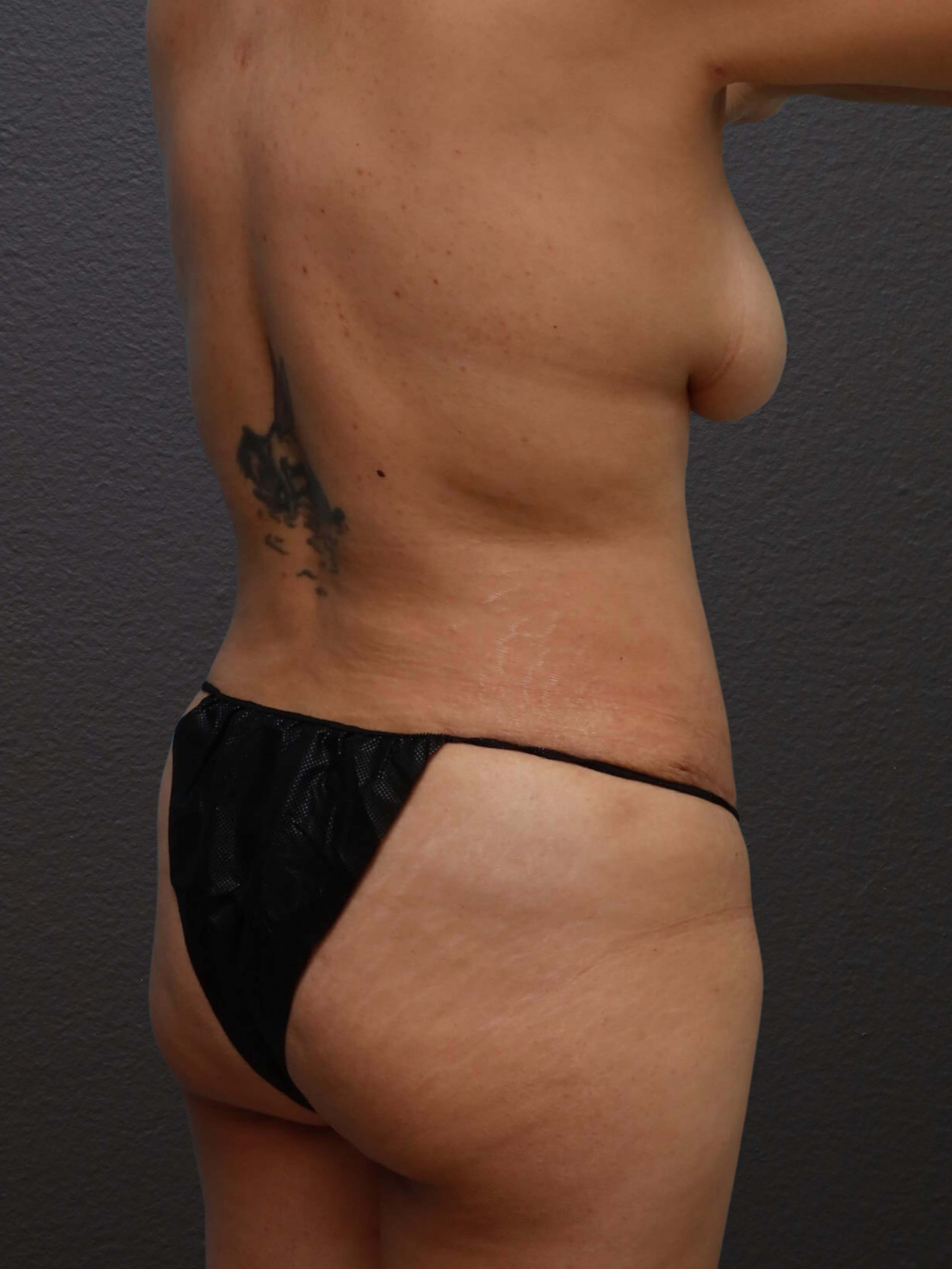 Right Back Oblique After