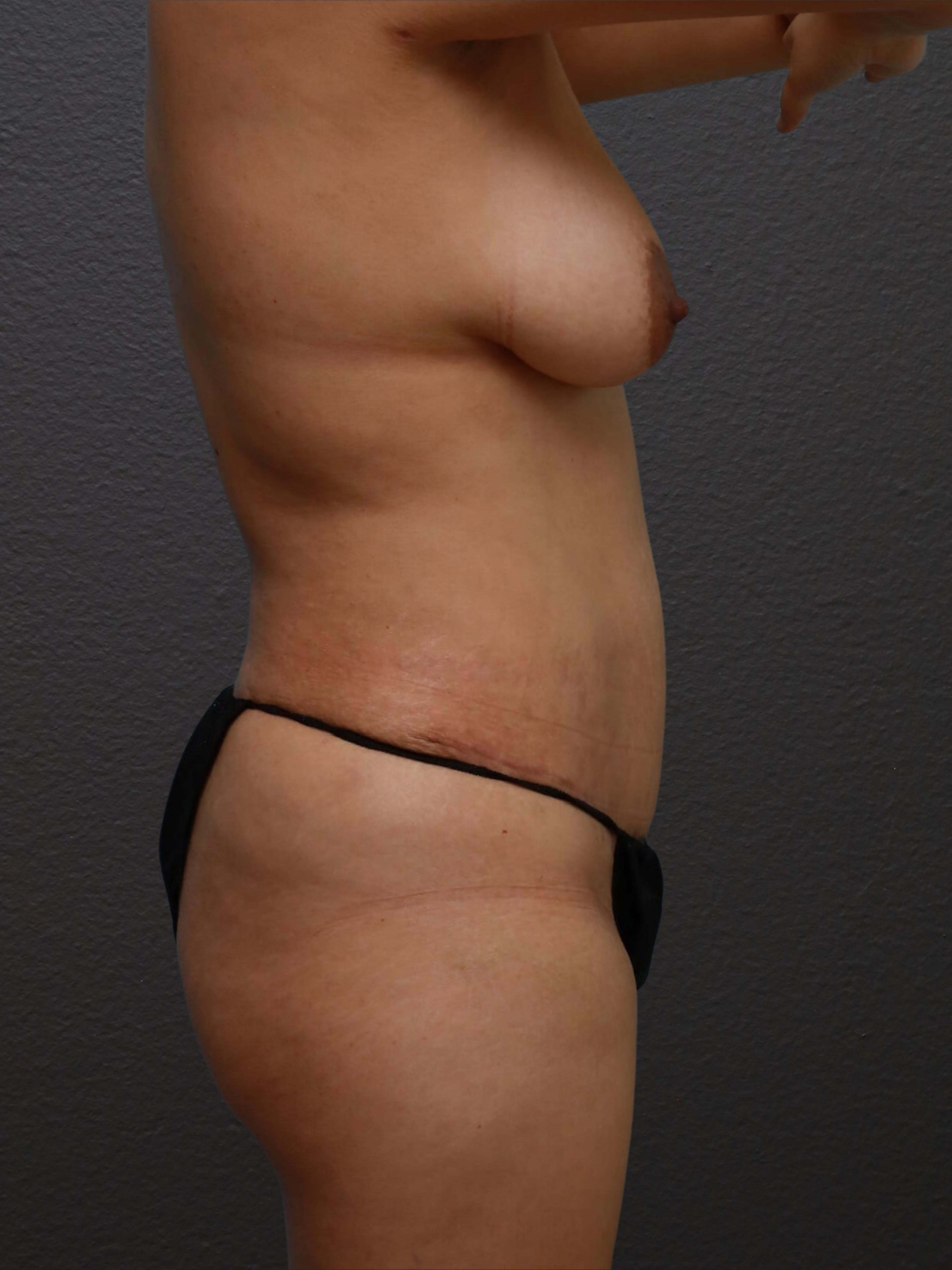Right Lateral After
