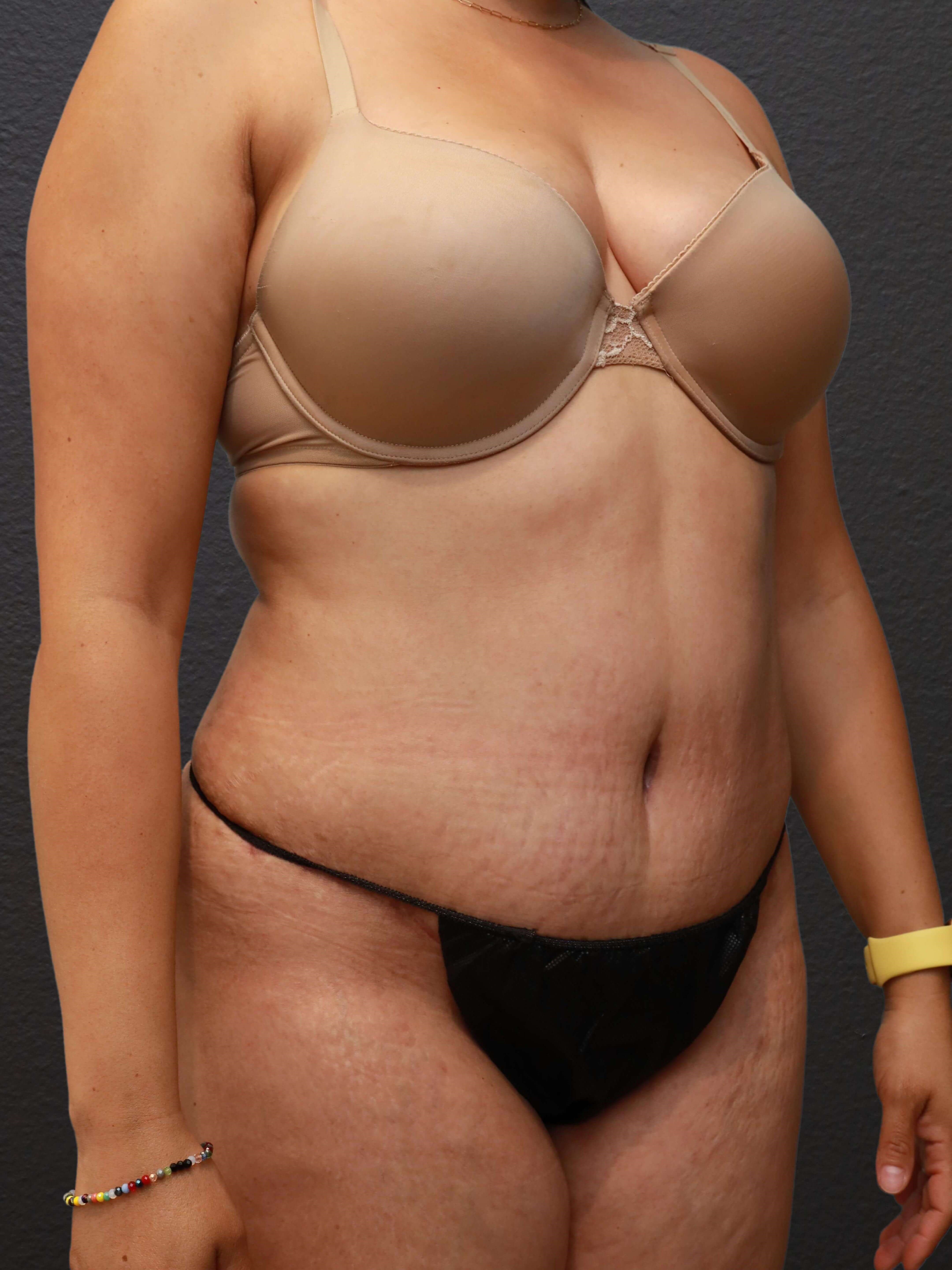 Right Oblique After