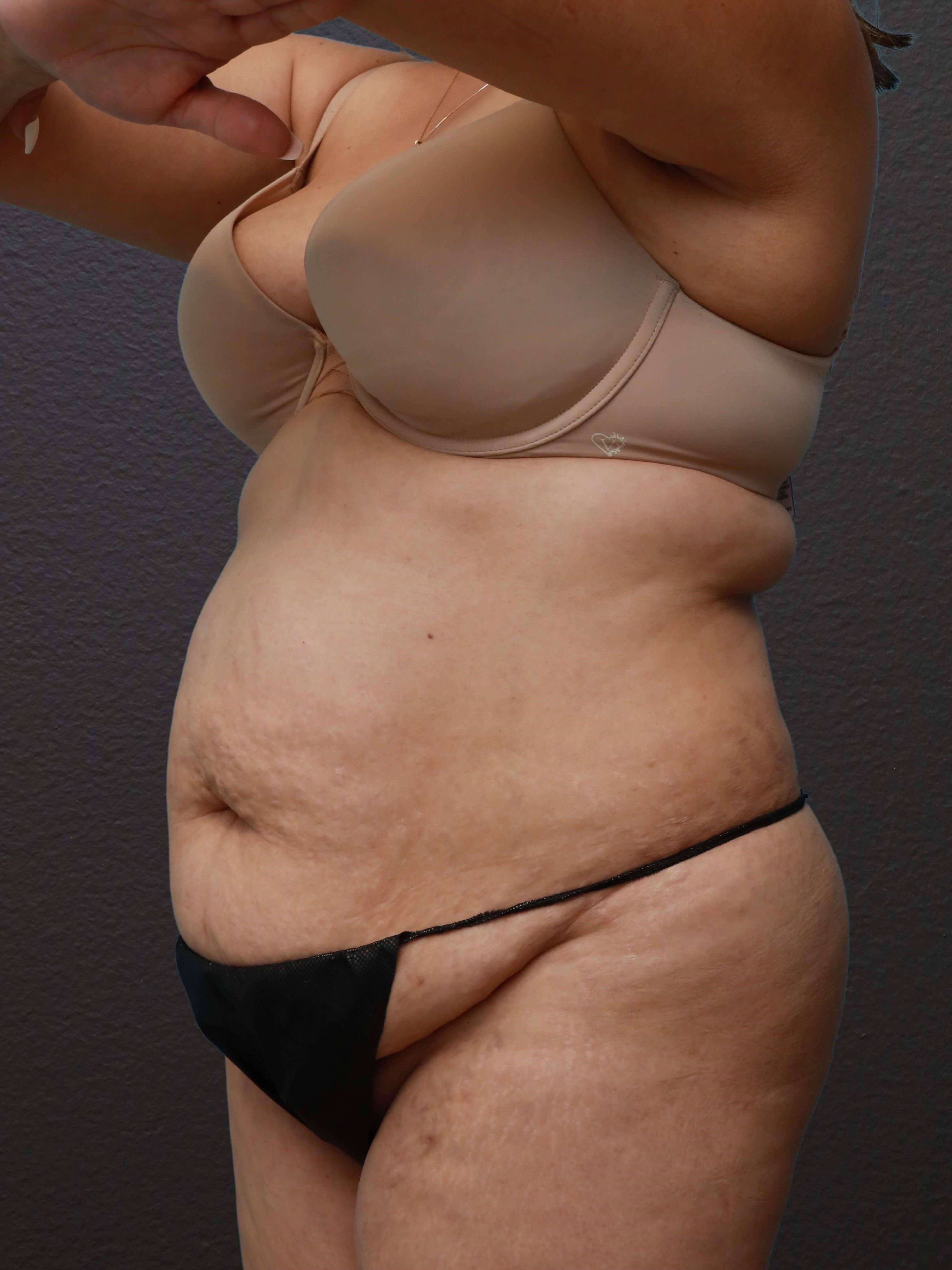 Left Oblique Before