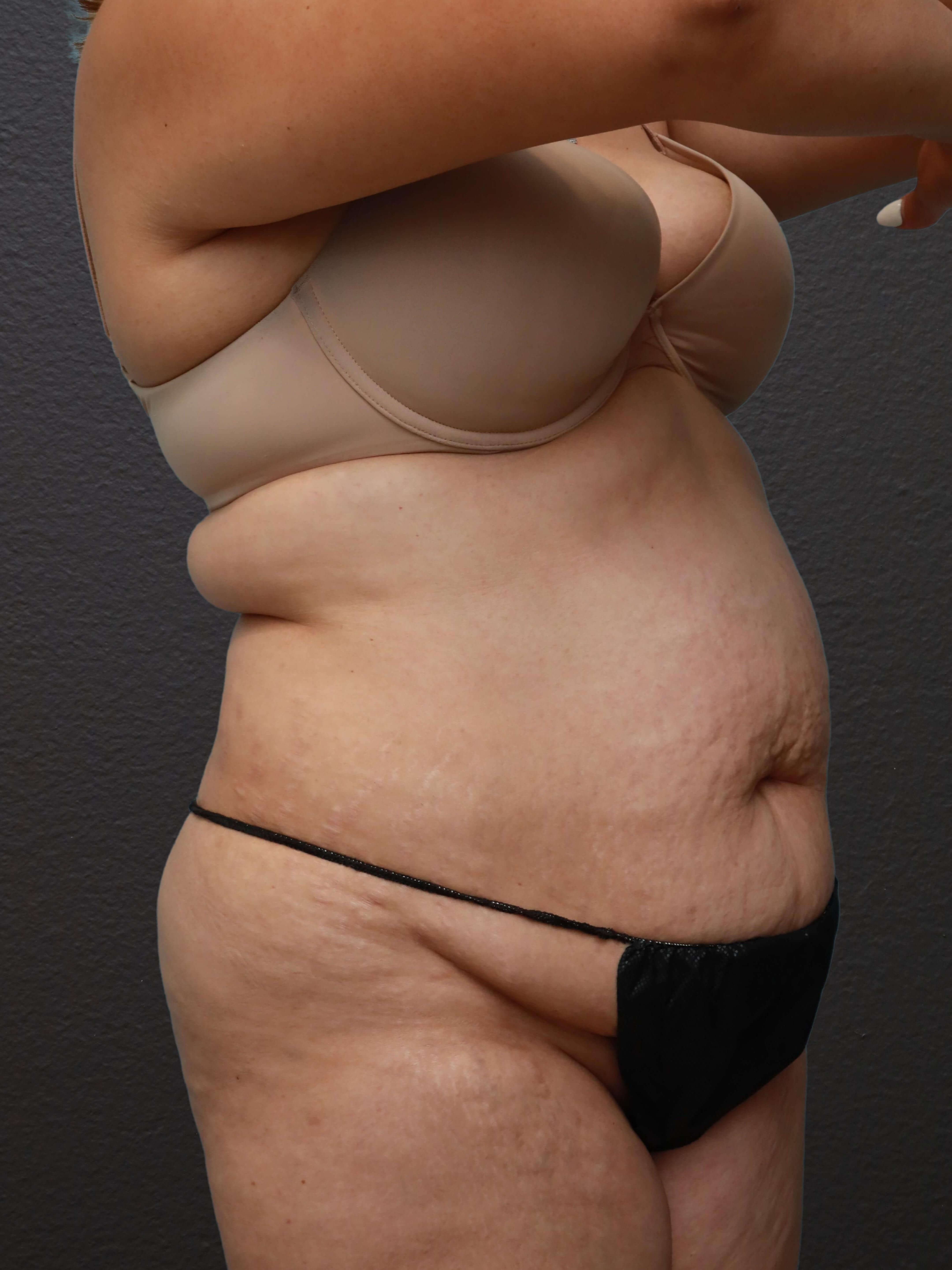 Right Oblique Before