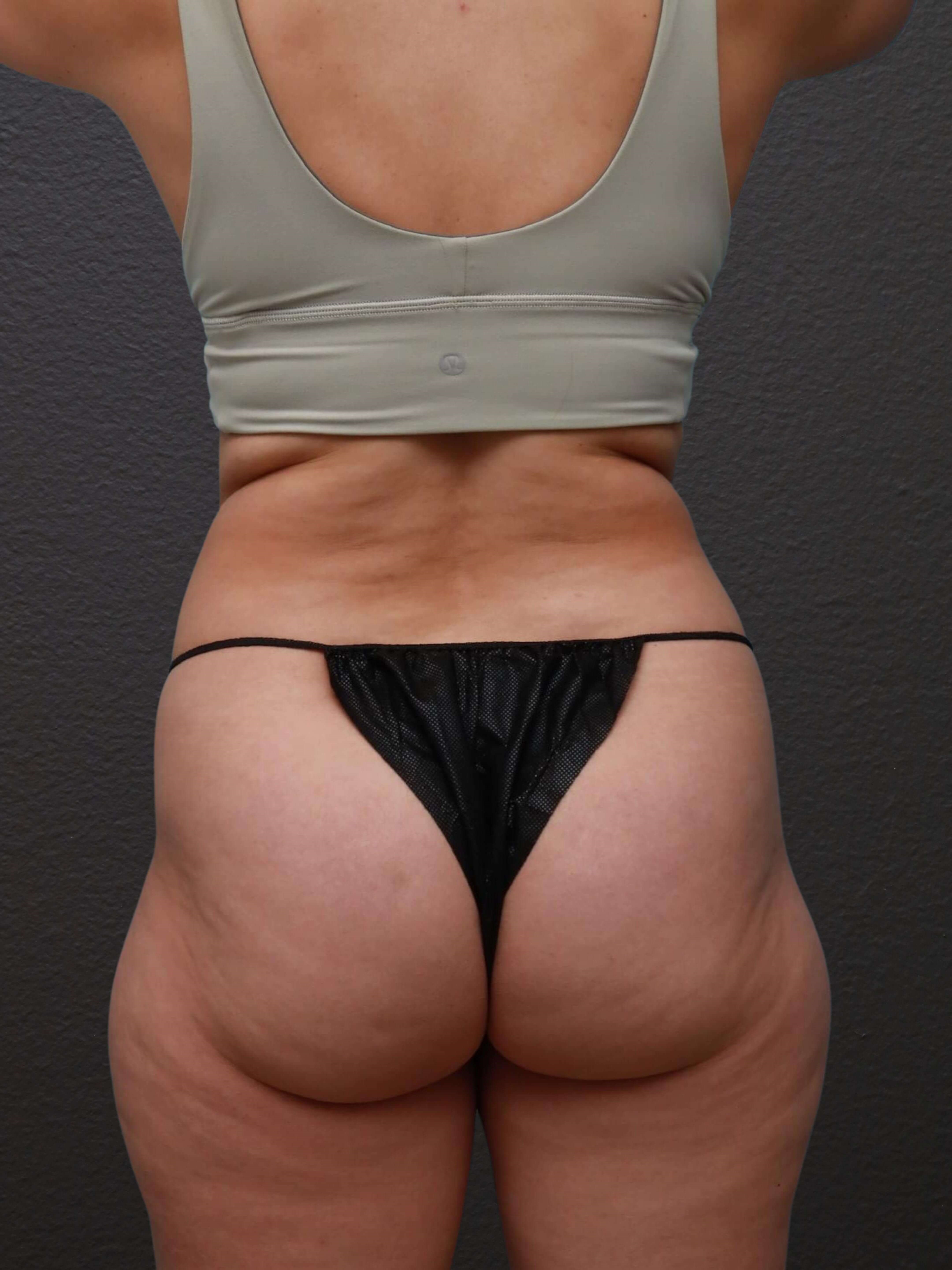 Posterior Before