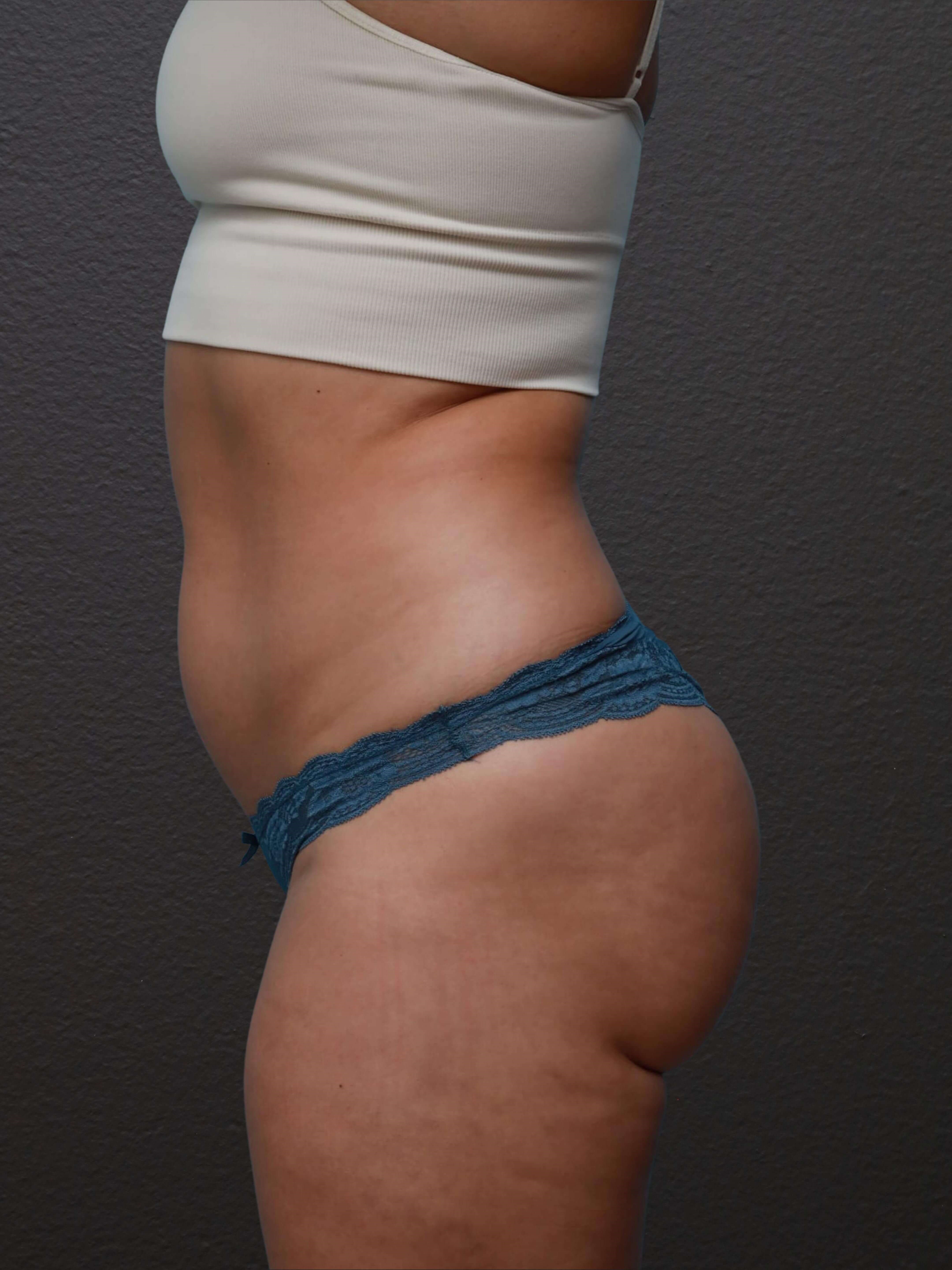Left Lateral After