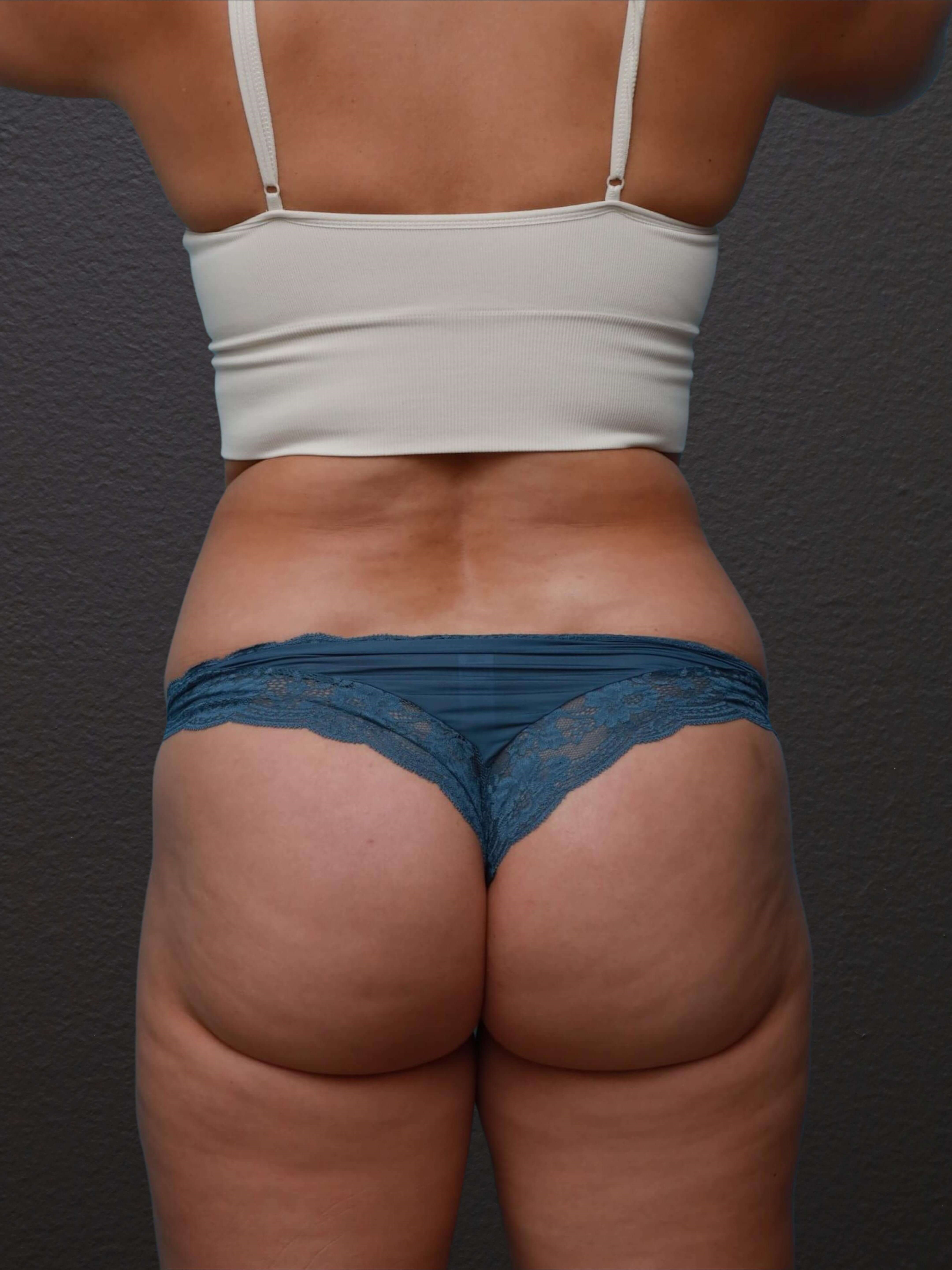 Posterior After