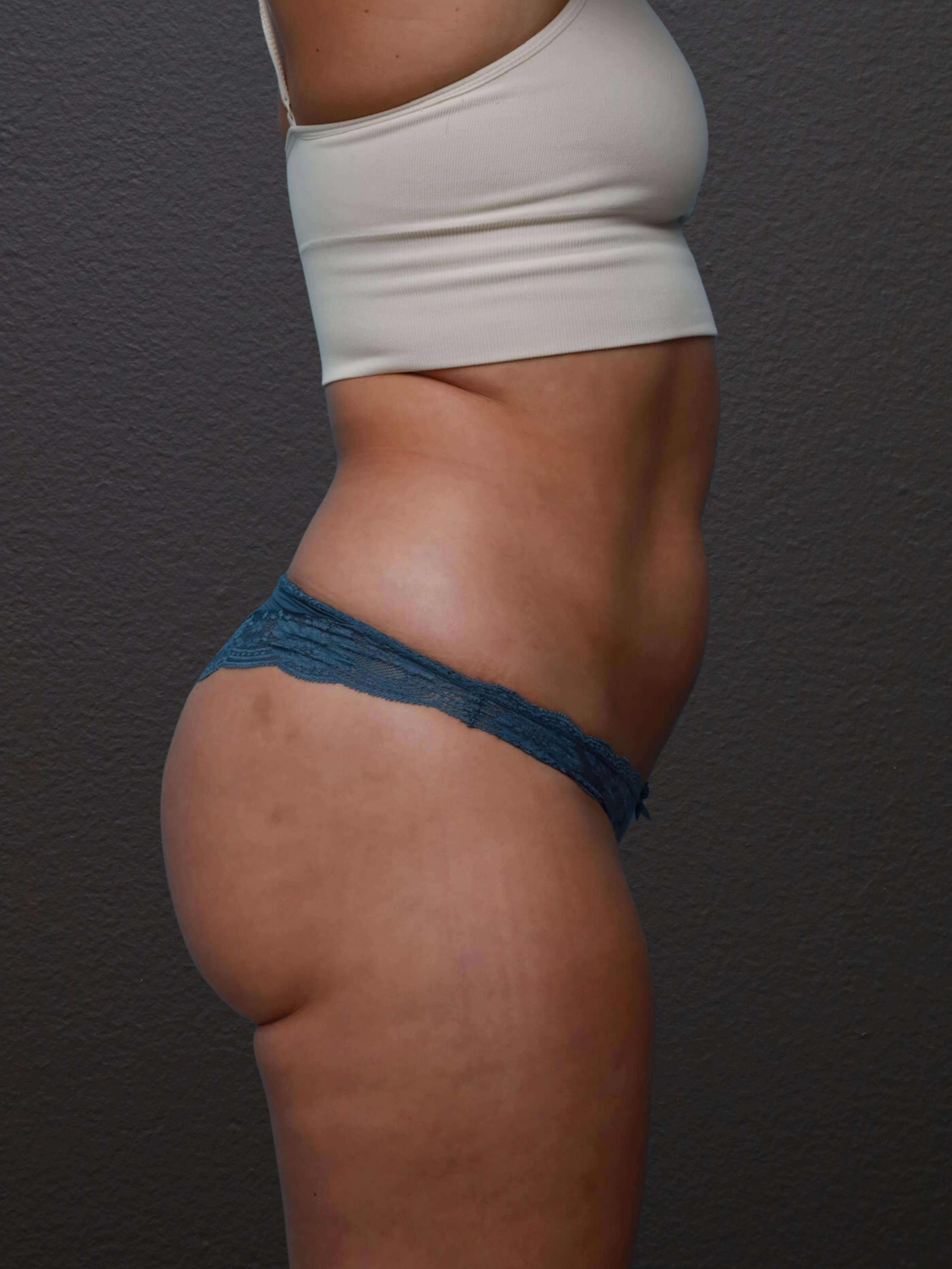 Right Lateral After