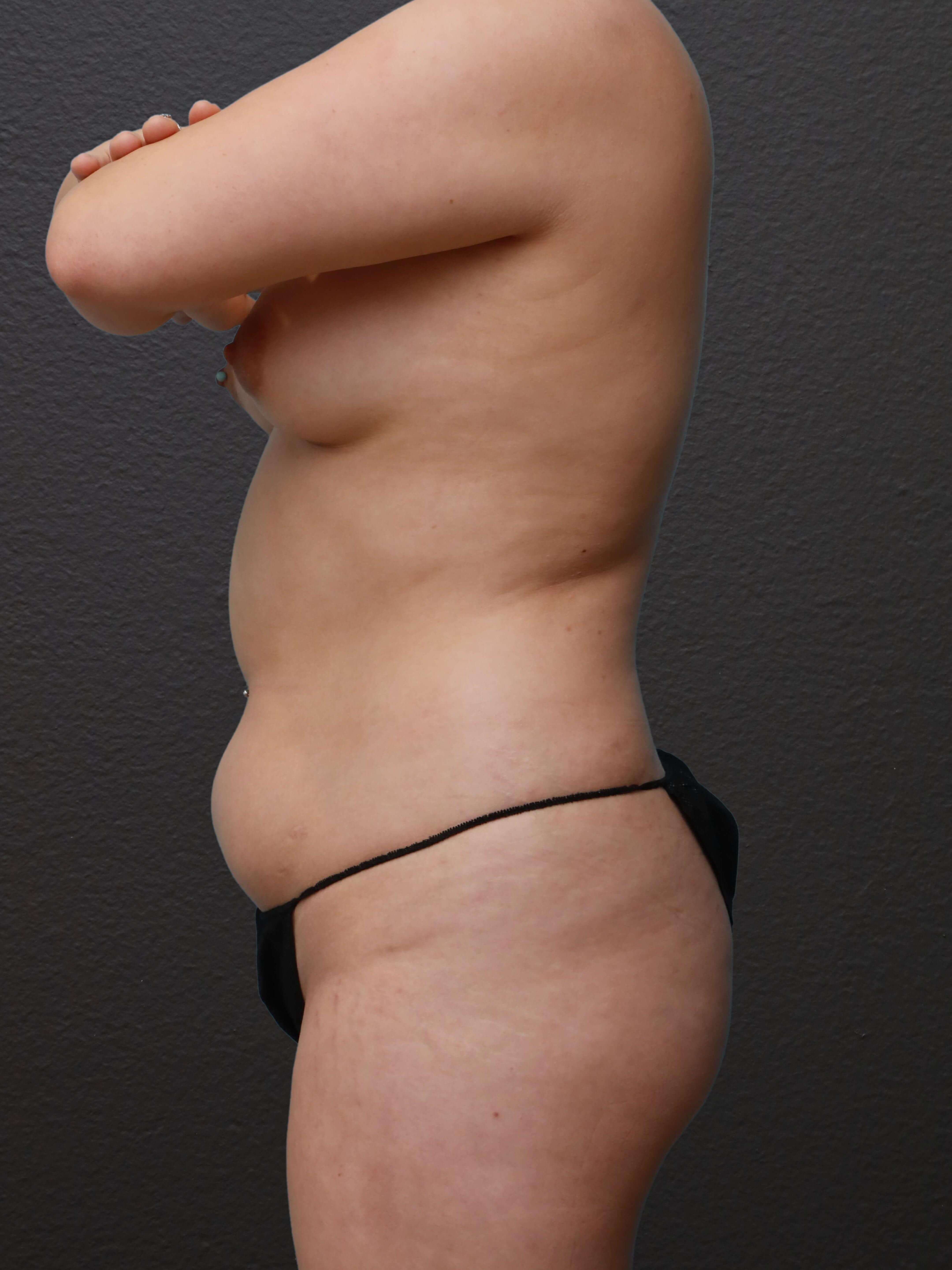 Left Lateral Before