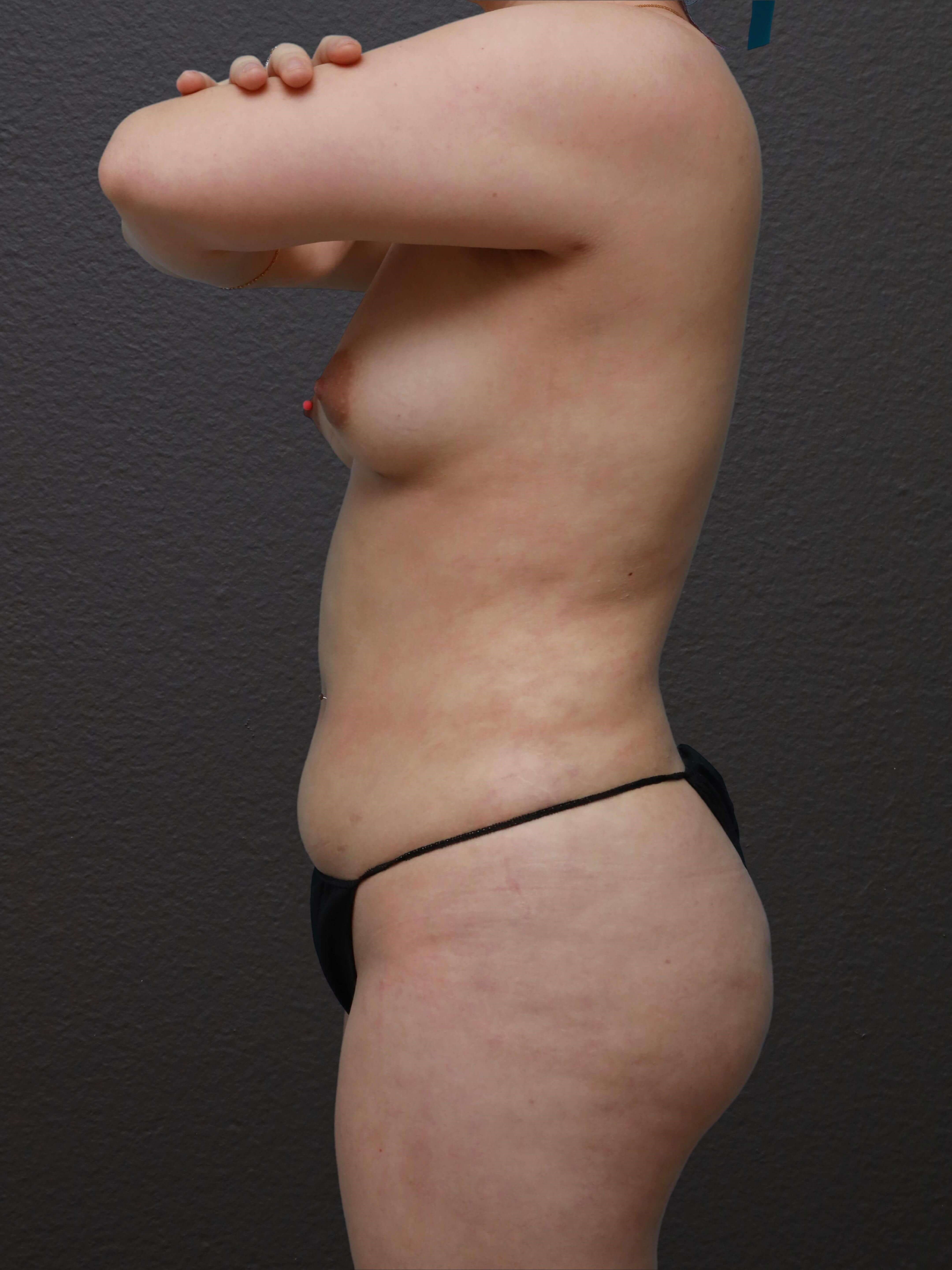 Left Lateral After