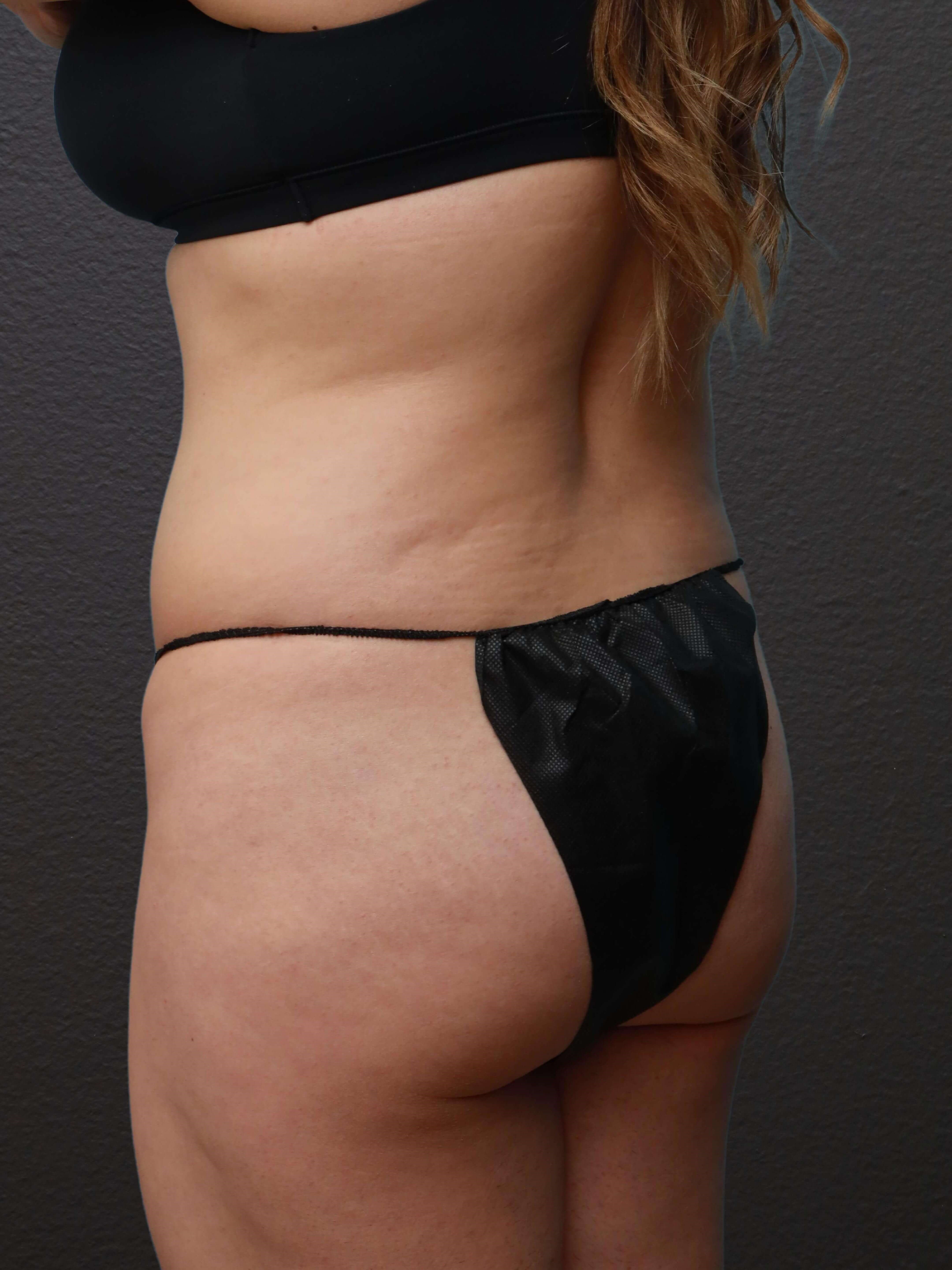Left Oblique Before