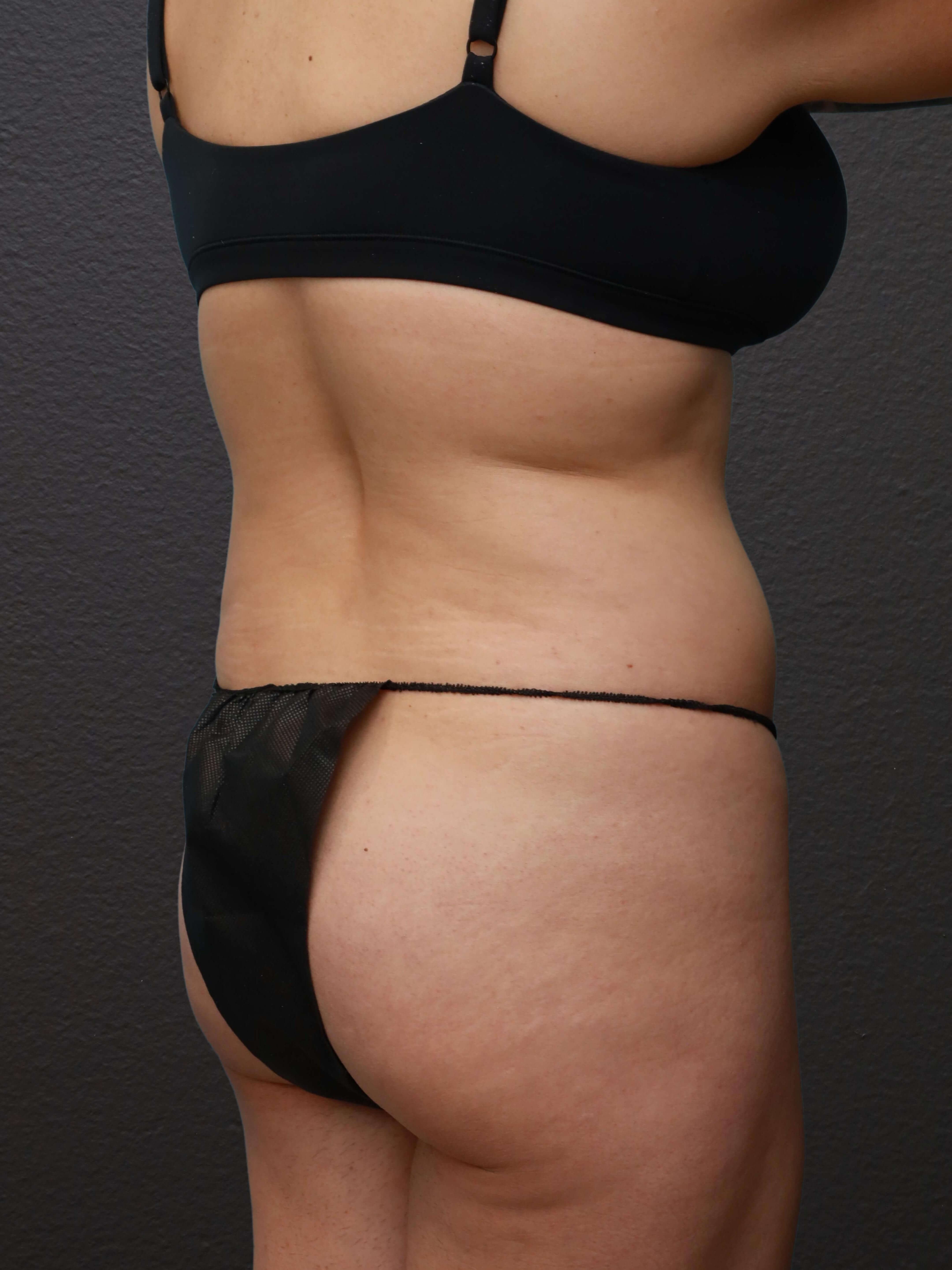 Right Oblique Before