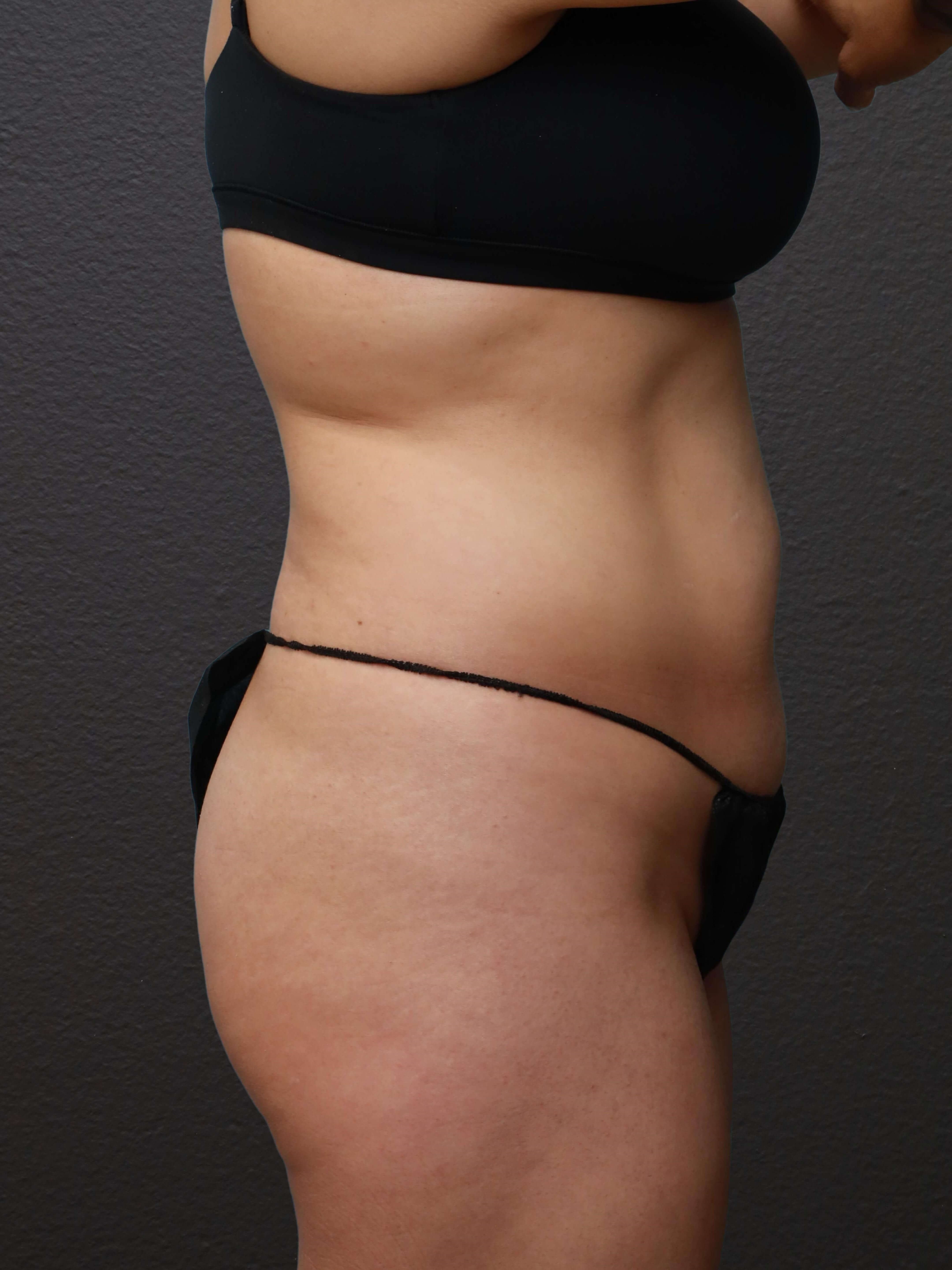Right Lateral Before