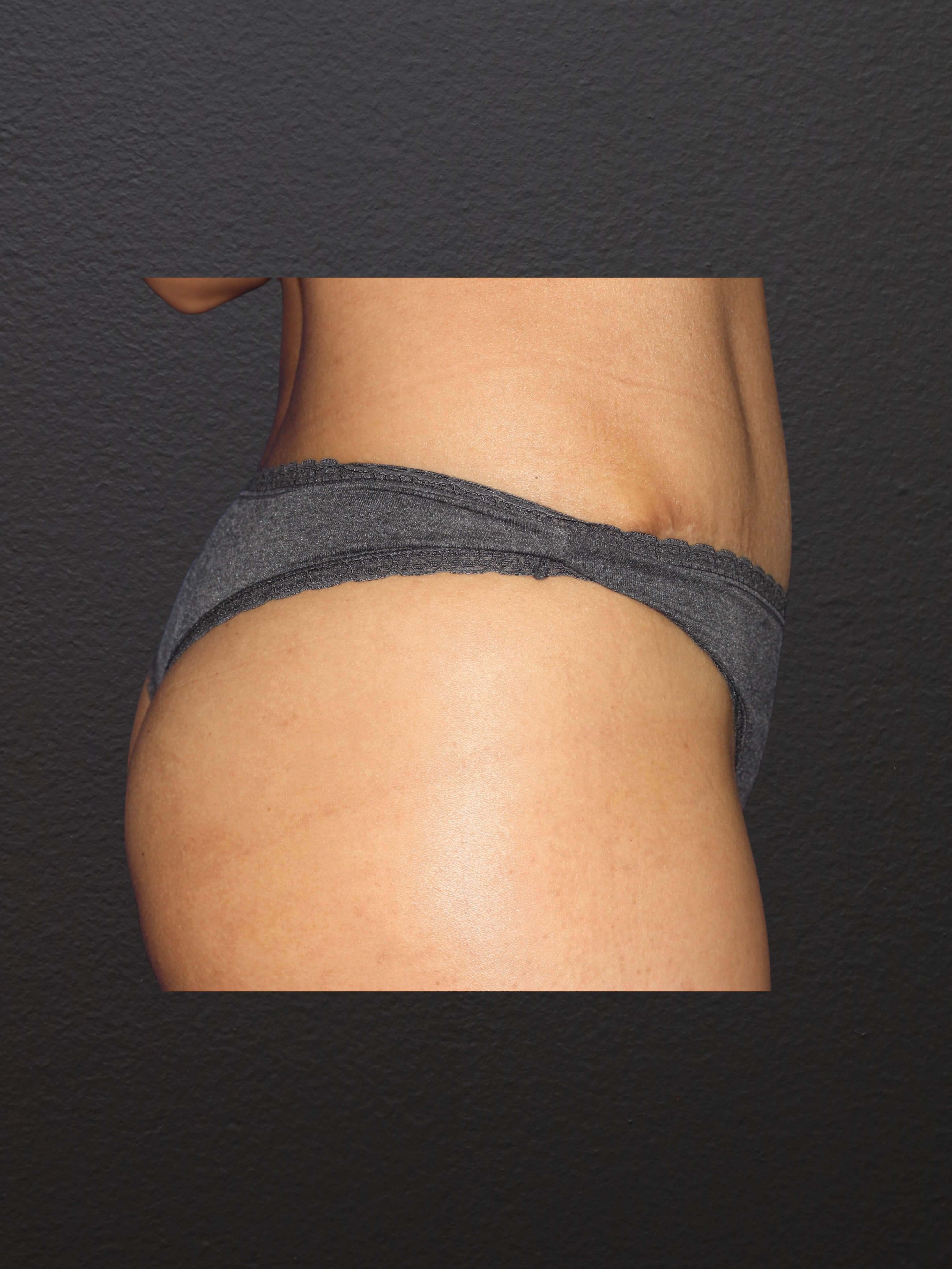 RIGHT LATERAL After