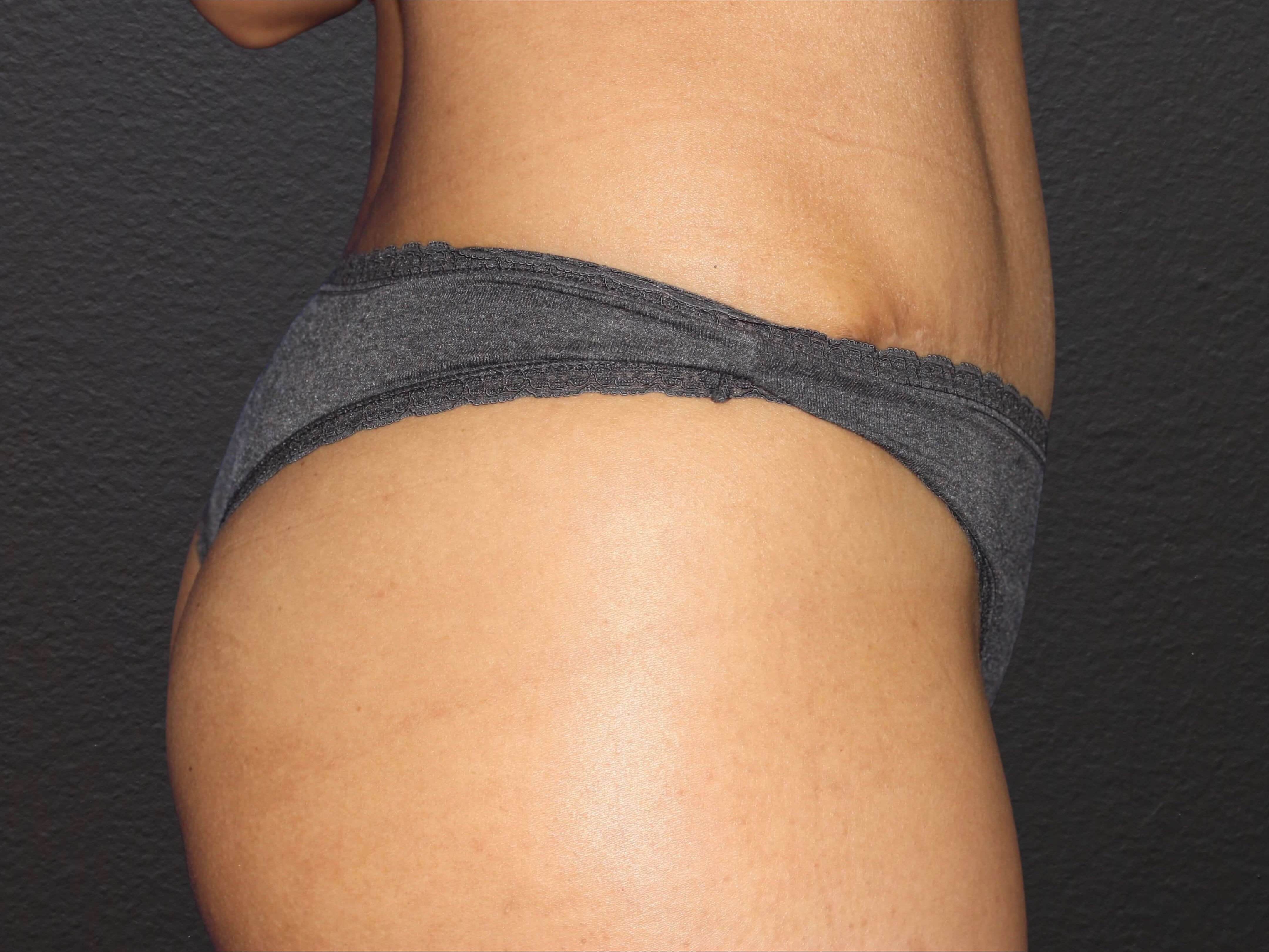 RIGHT LATERAL After