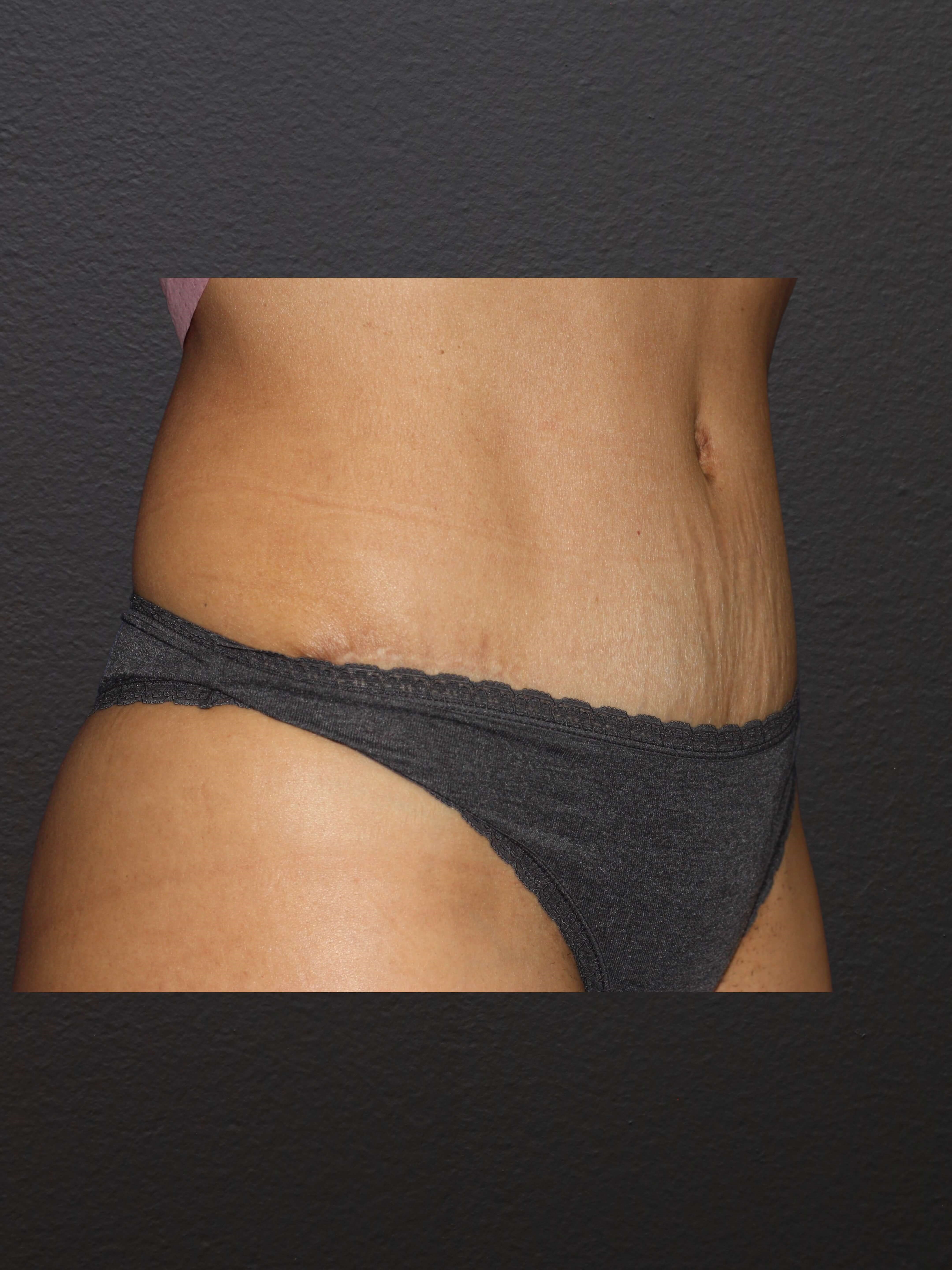 RIGHT OBLIQUE After