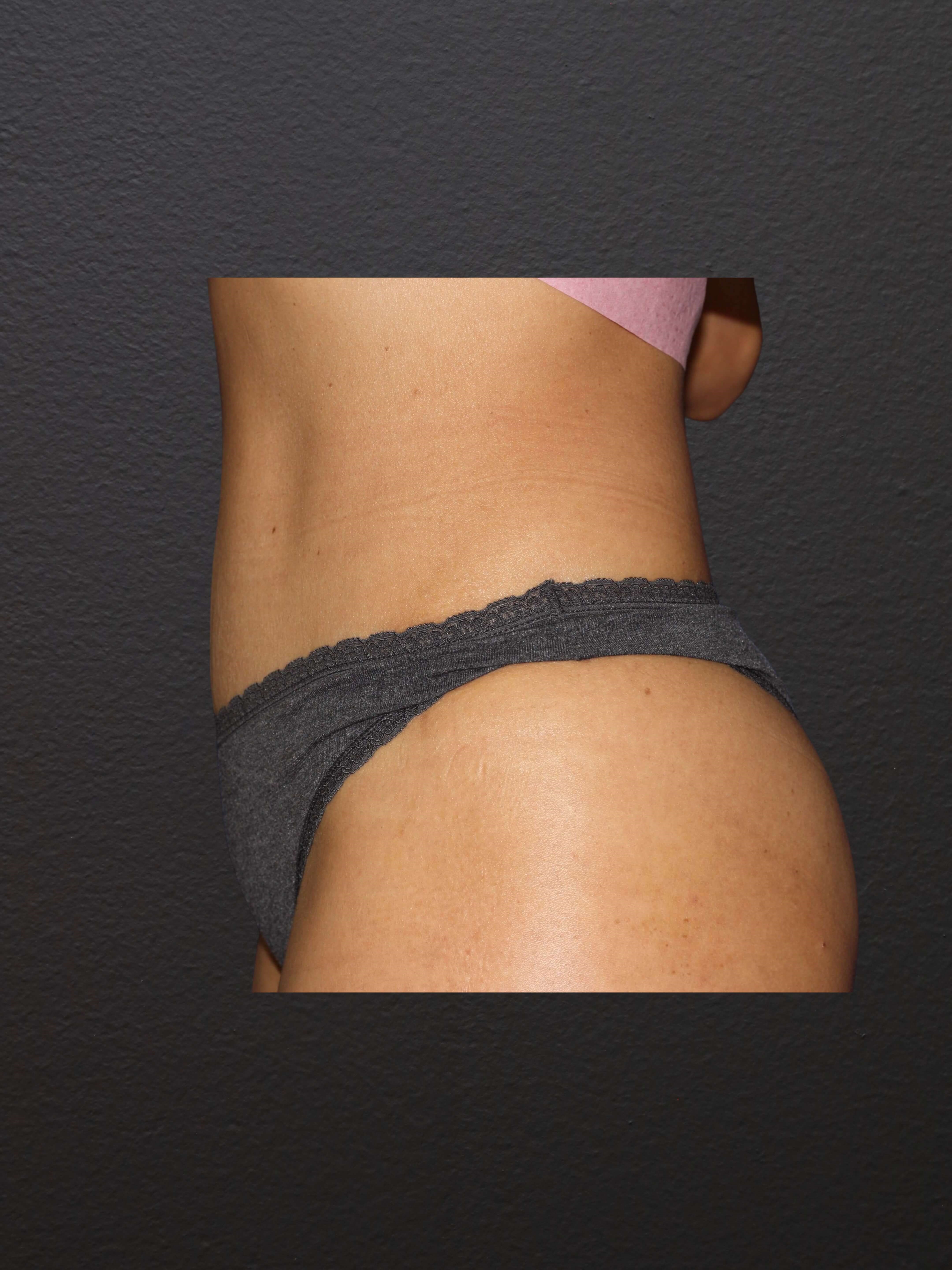 LEFT LATERAL After
