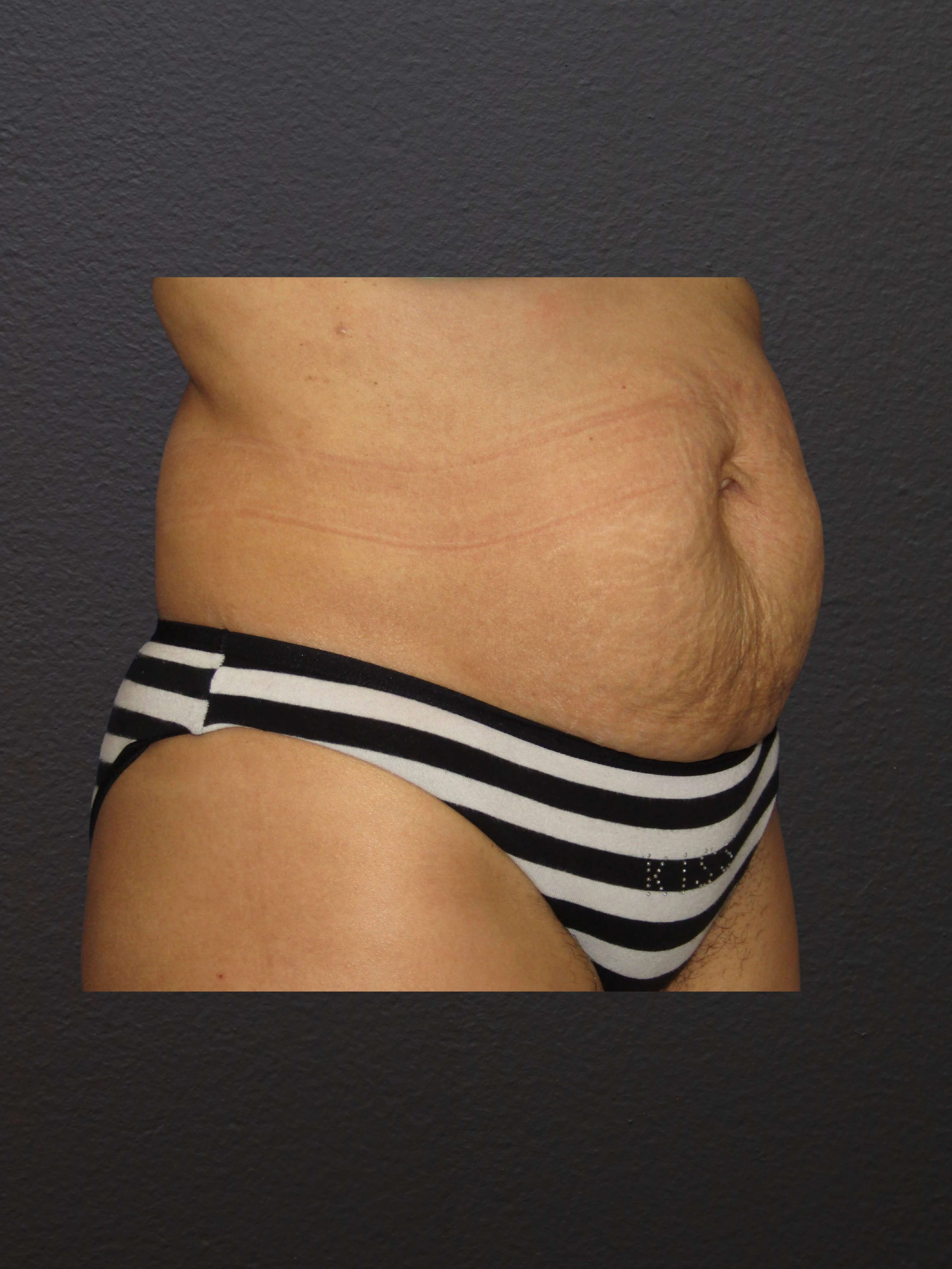 RIGHT OBLIQUE Before
