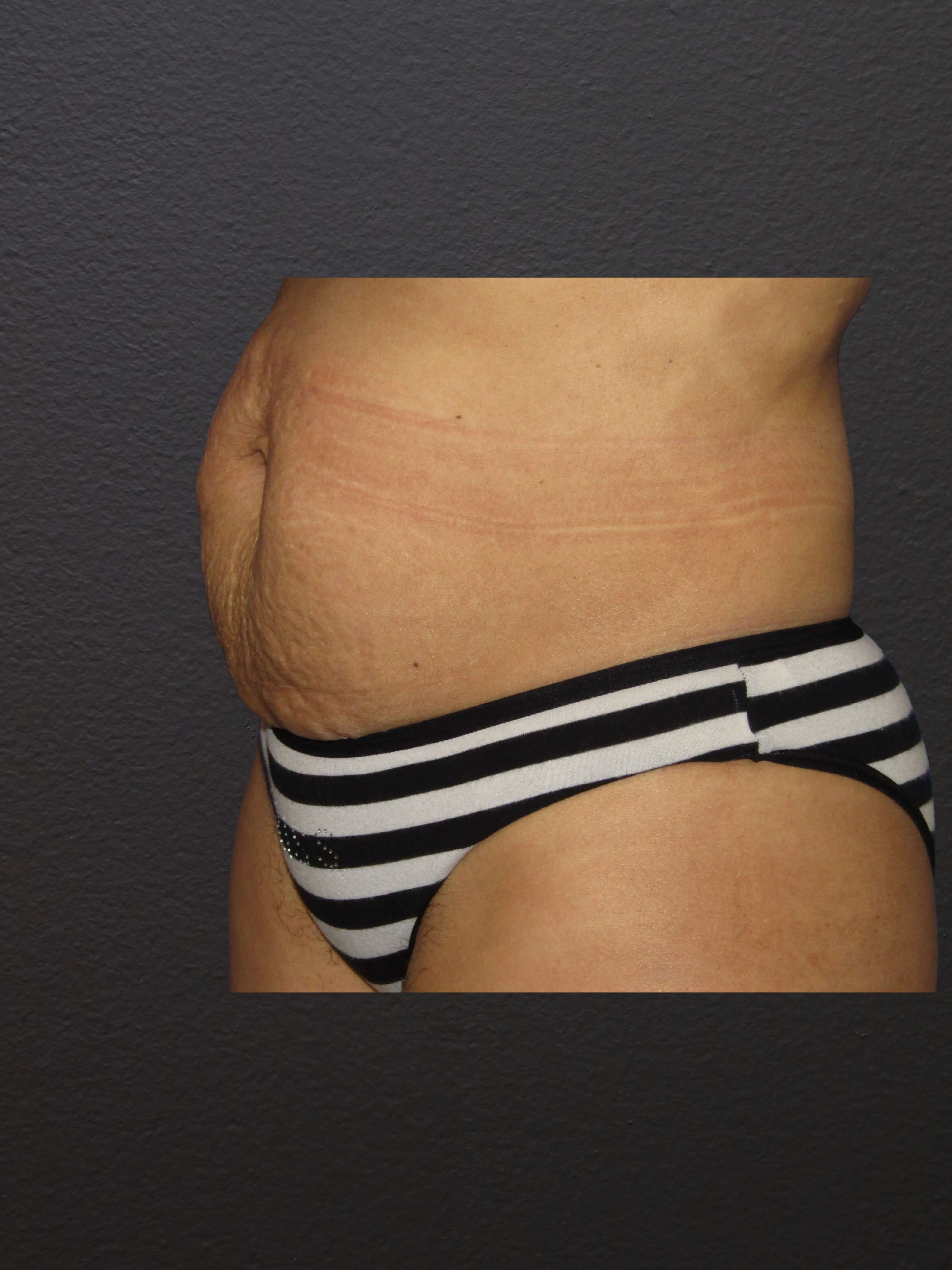 LEFT OBLIQUE Before
