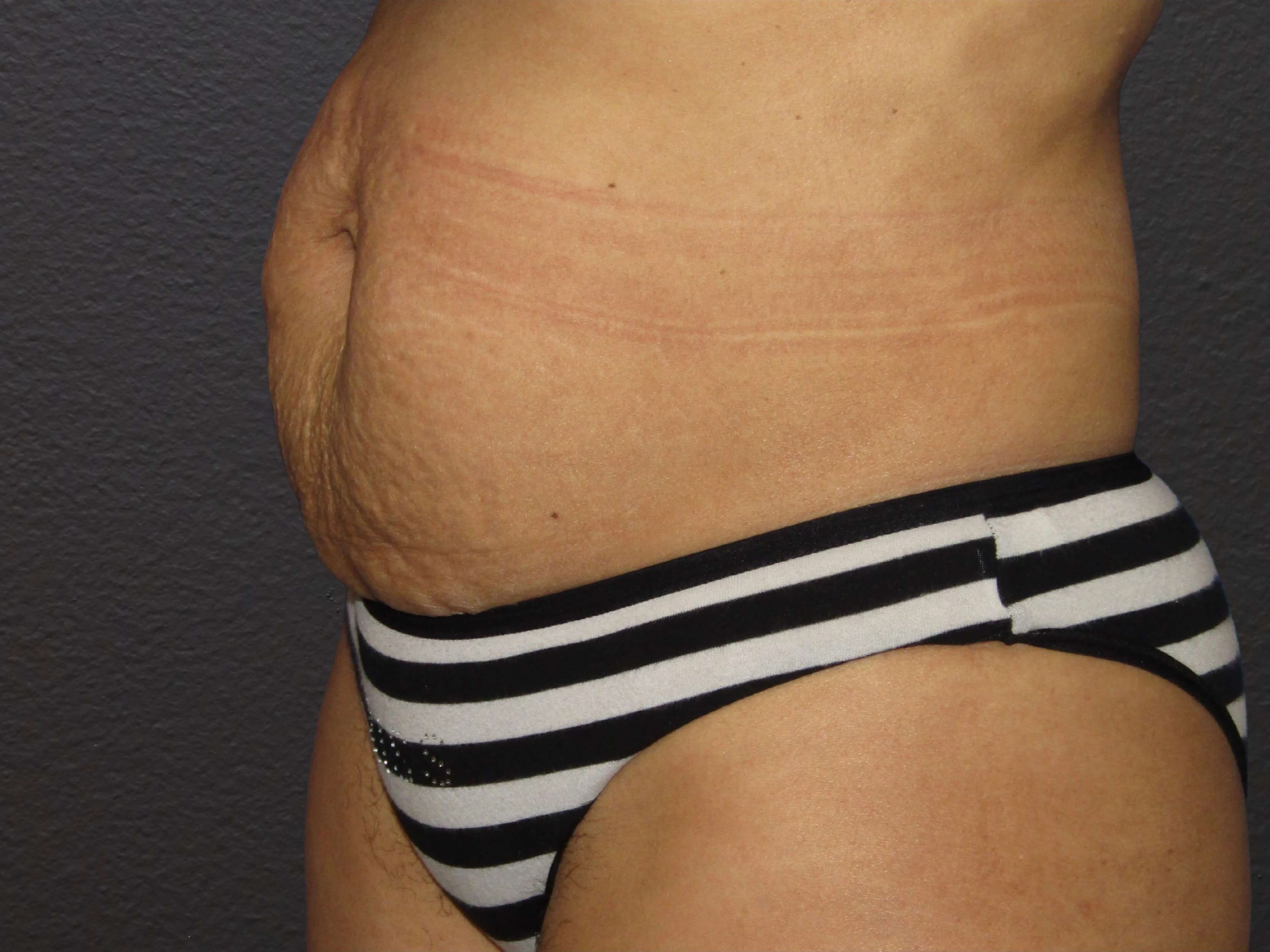 LEFT OBLIQUE Before