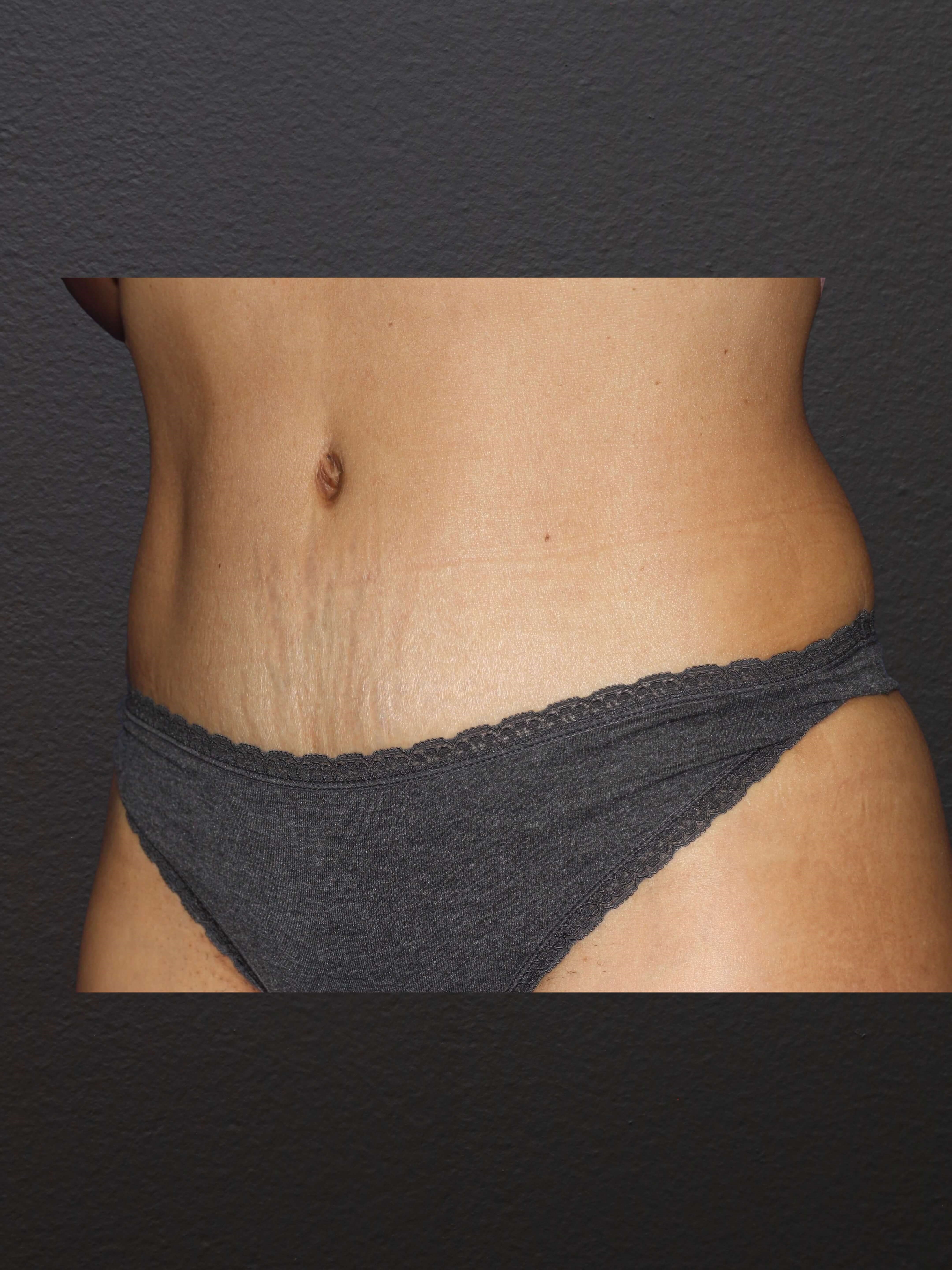 LEFT OBLIQUE After