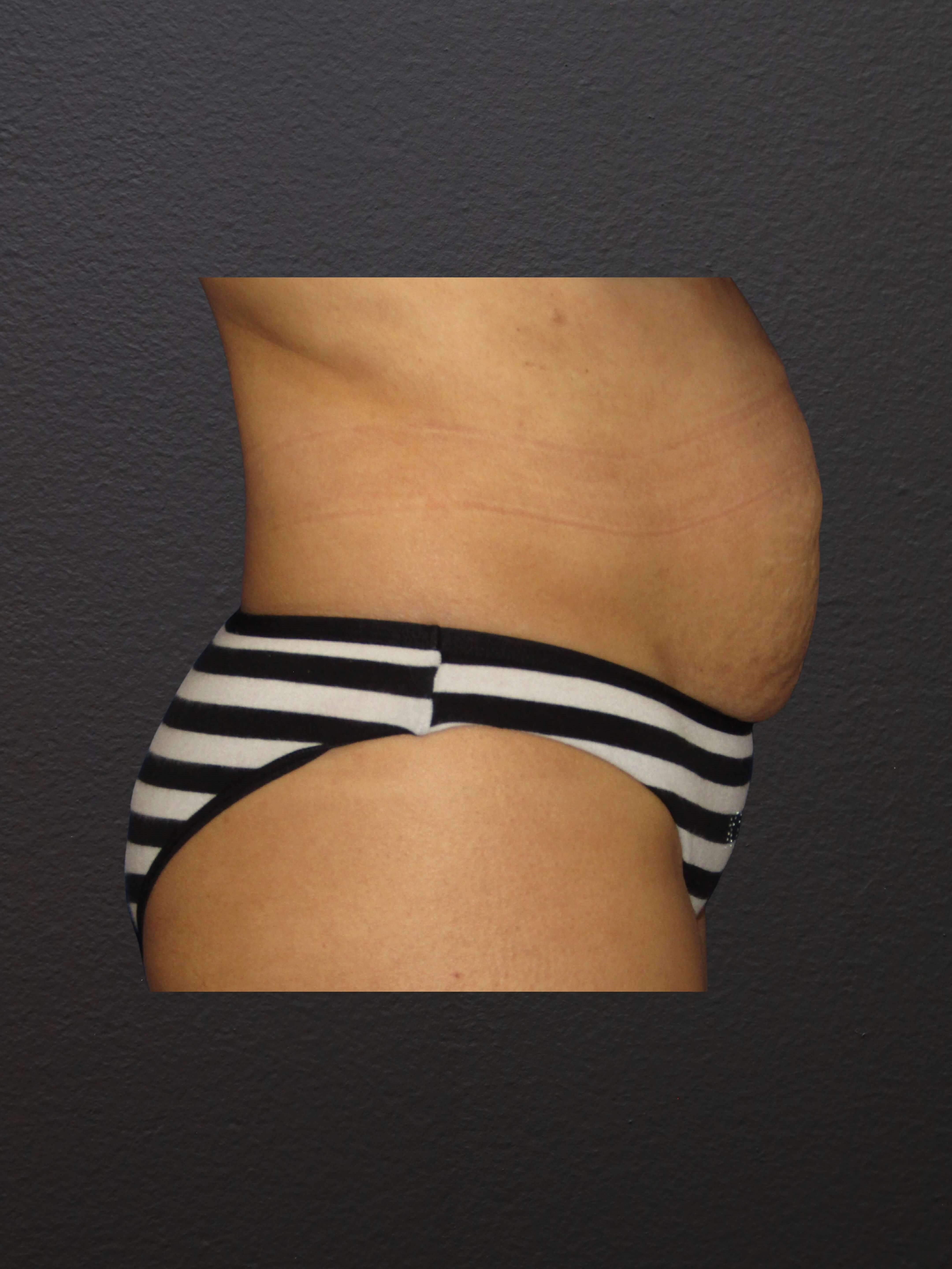 RIGHT LATERAL Before