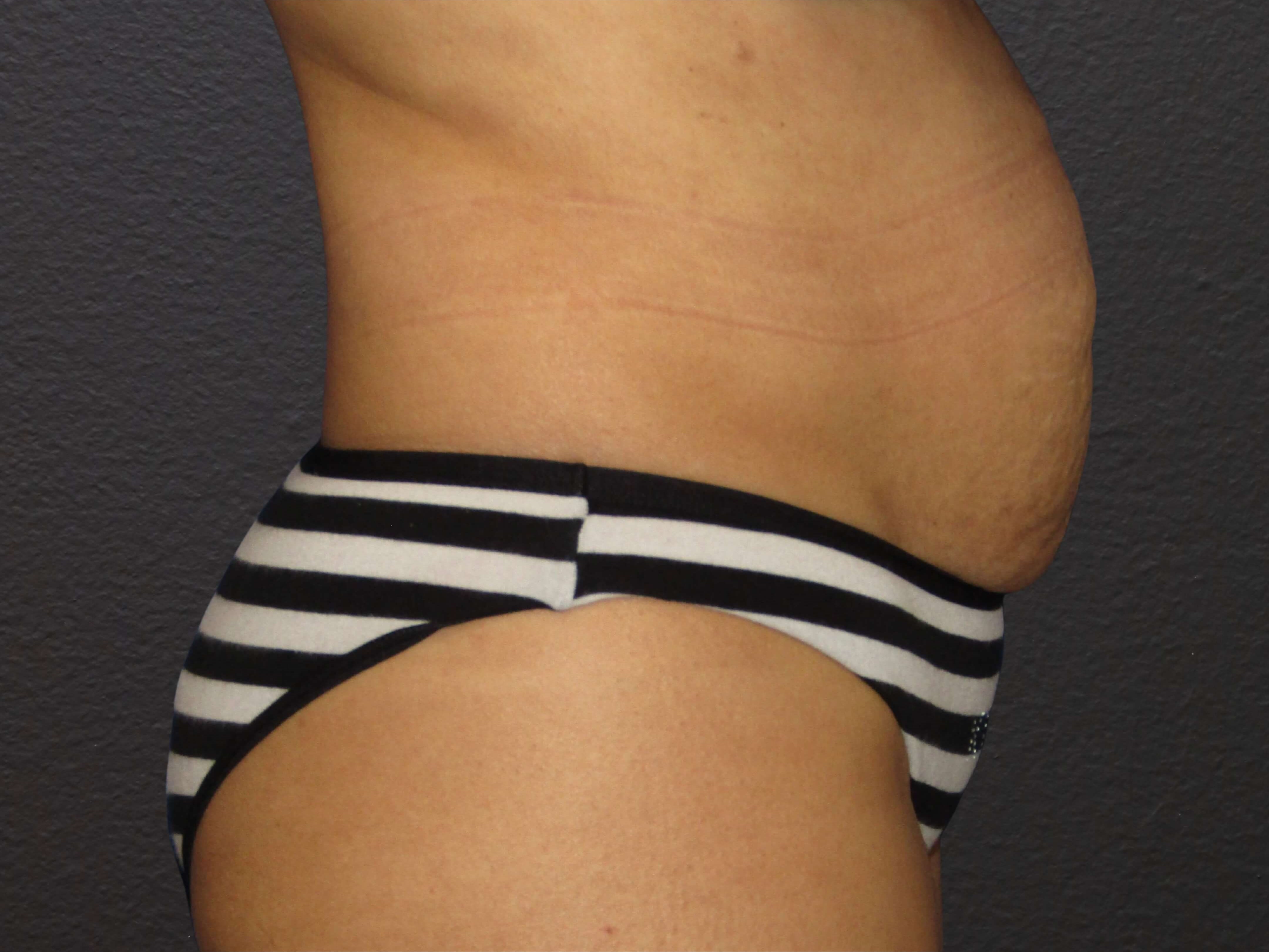 RIGHT LATERAL Before
