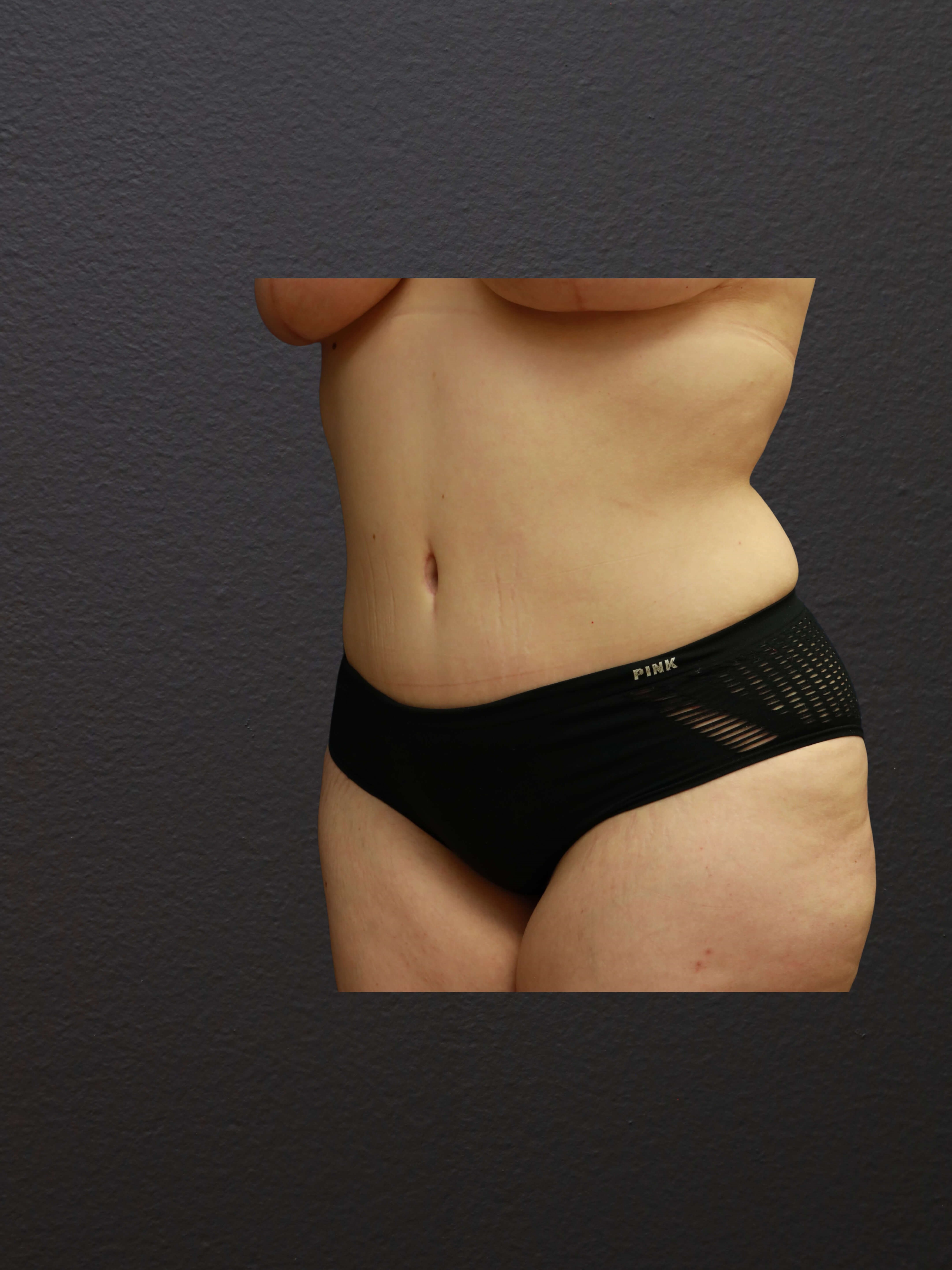 LEFT OBLIQUE After