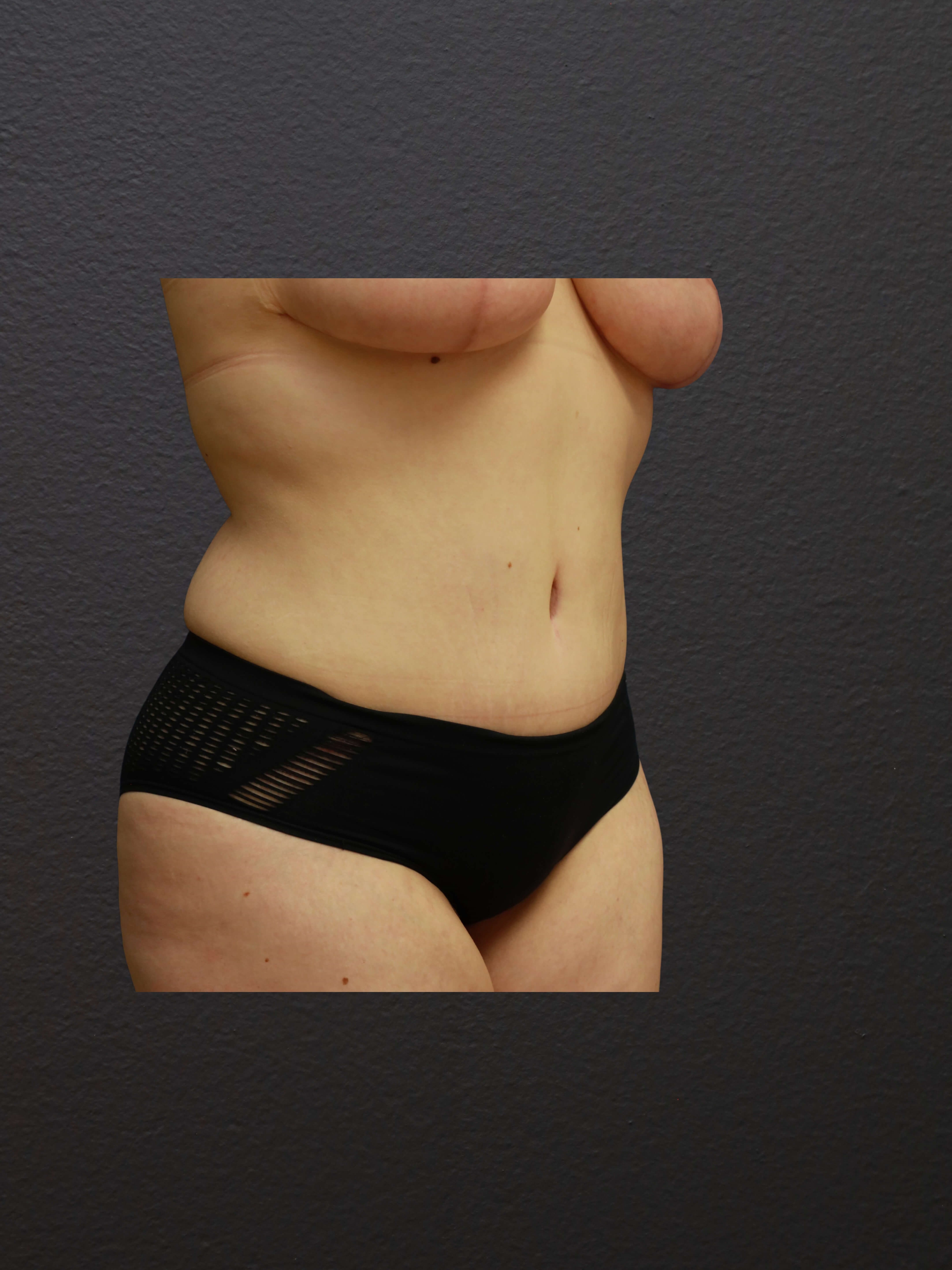 RIGHT OBLIQUE After