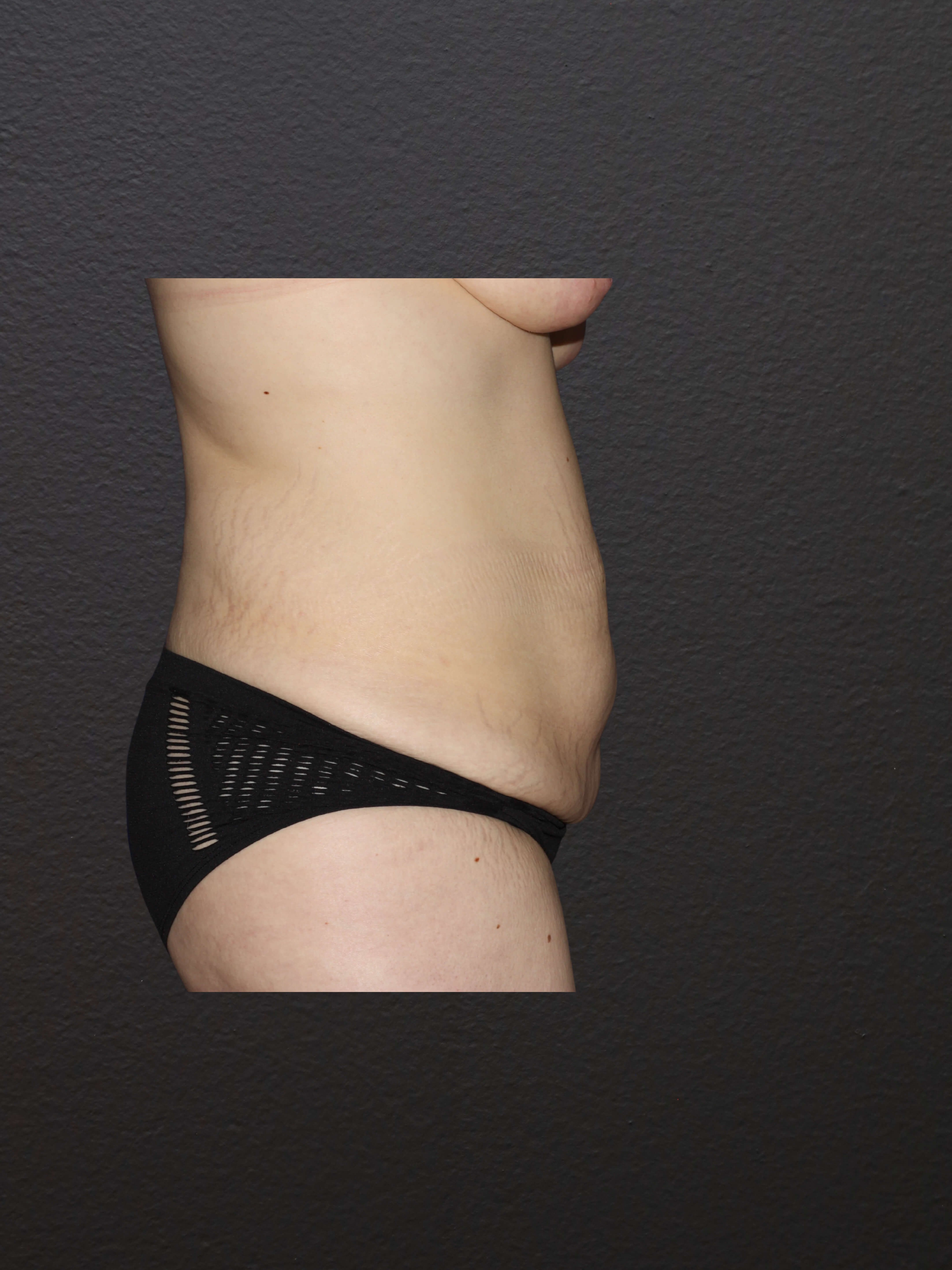 RIGHT LATERAL Before